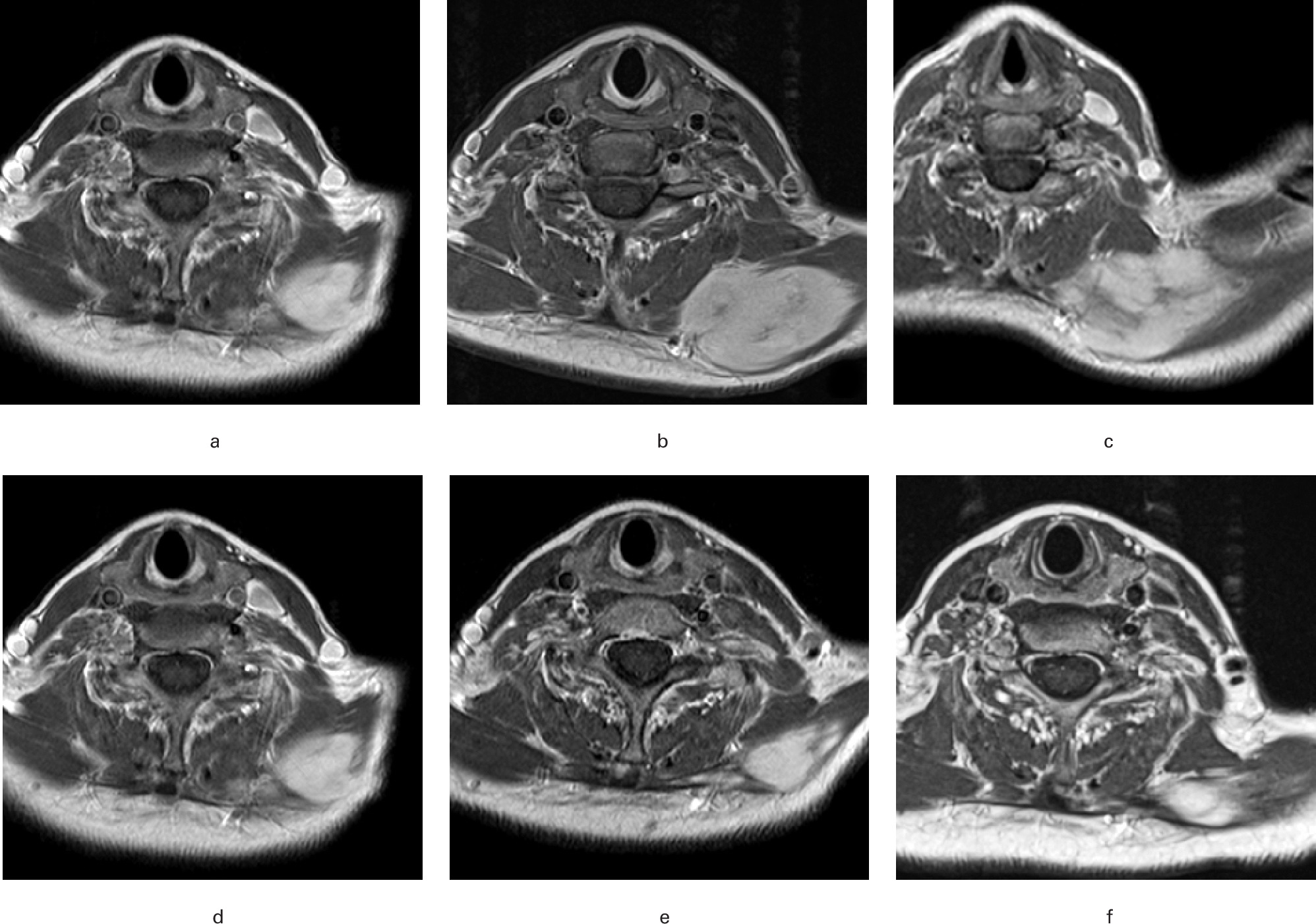 Fig. 1 
          Example of the spontaneous regression of a desmoid tumour. A 48-year-old female presented with a mass in the left shoulder, without any associated symptoms. a) An MRI scan showed a swelling measuring about 5 cm in diameter at the level of the trapezius muscle. A biopsy confirmed the diagnosis of a desmoid tumour. Active surveillance was initiated with clinical and diagnostic monitoring, every one to two months. b) The MRI scans during the first year showed a significant increase in the size but, considering the location and the persistently absent symptoms, the patient did not receive active treatment. c) There was a subsequent spontaneous arrest of growth and stabilization, d) about two years after the diagnosis. Further MRI scans after e) another six months and f) a year.
        