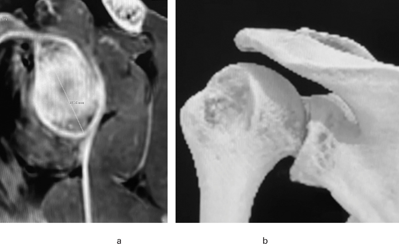 Fig. 1 
            MRI volumetric interpolated breath-hold examination sequence showing a) 2D sagittal en face view and b) 3D view.
          