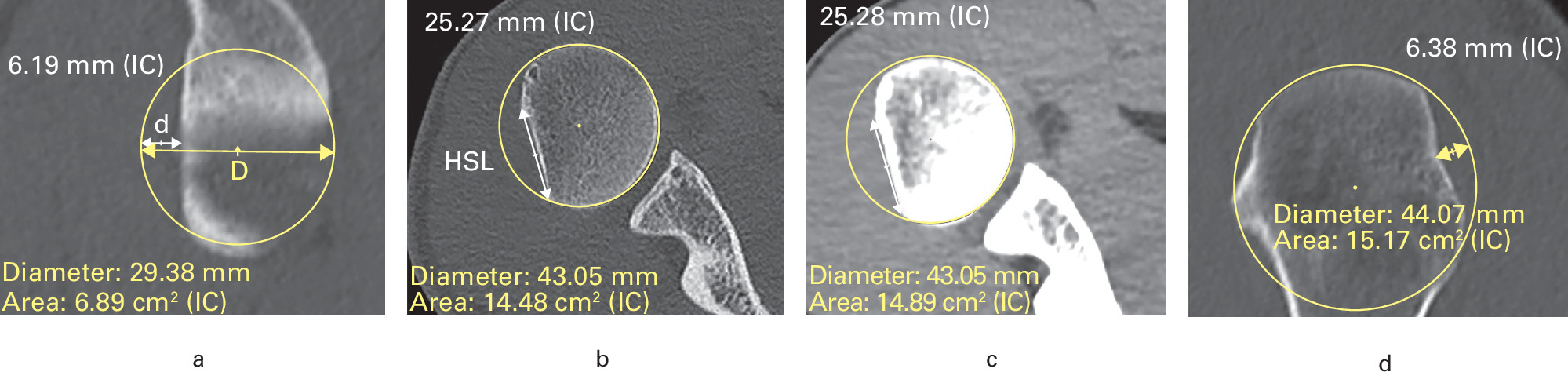 Fig. 3 
            a) CT showing an off-track lesion. b) Glenoid track (0.83D – d) is smaller than the width of the Hill-Sachs lesion. c) A soft-tissue CT window showing infraspinatus insertion helps in accurately measuring the Hill-Sachs lesion width. d) Sagittal CT view shows the Hill-Sachs lesion depth.
          