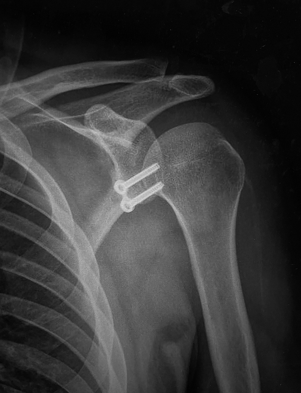 Fig. 4 
            Radiograph showing a left shoulder two months after a classic Latarjet procedure with screw fixation.
          