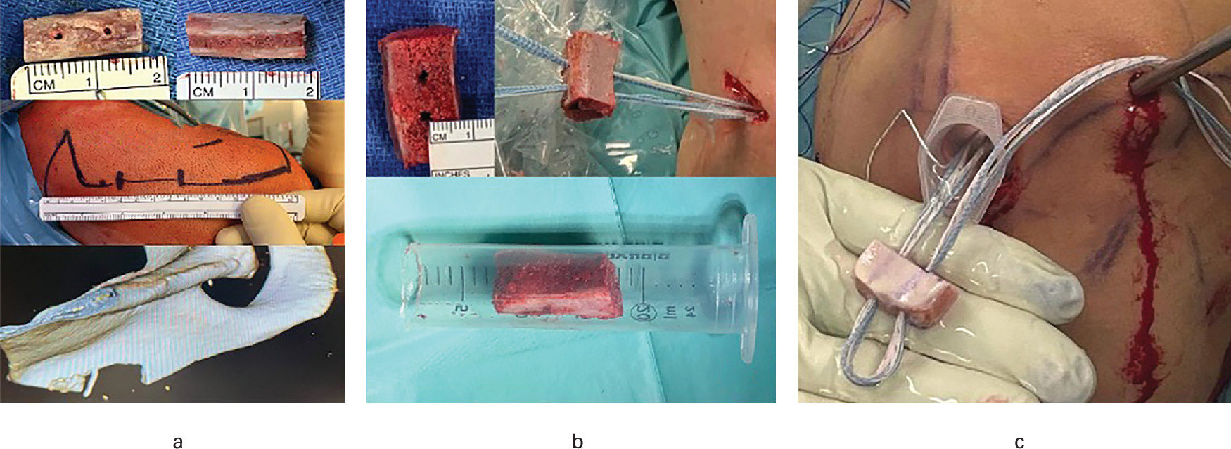 Fig. 6 
          Different types of graft that may be used with the bone block procedure fixed with a Fibertape cerclage procedure are shown. a) Scapula spine. b) Iliac crest. c) Distal tibial allograft.
        