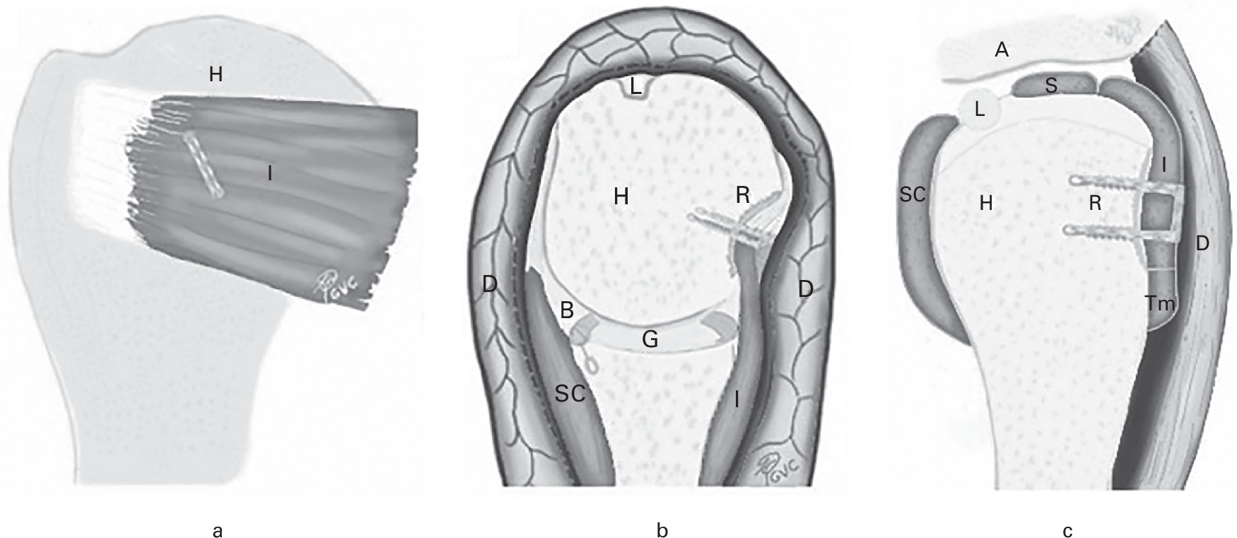 Fig. 9 
          a) Coronal, b) axial, and c) sagittal views of arthroscopic remplissage technique with knotless tape bridge for Hill-Sachs lesion. A, acromion; B, Bankart lesion; D, deltoid; G, glenoid; H, humeral head; I, infraspinatus muscle; L, long head of biceps; R, remplissage; S, supraspinatus muscle; SC, subscapularis muscle; Tm, teres minor.
        