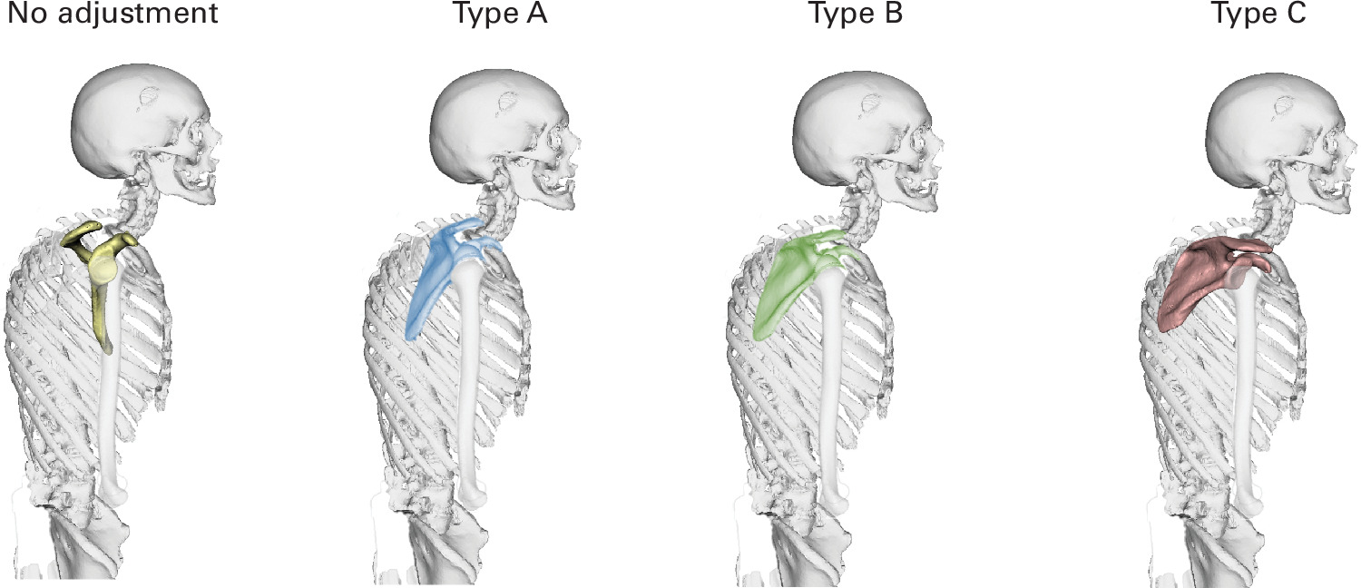 Fig. 3 
            Illustration of different scapulothoracic orientations in space in a type C patient. The scapula either did not adjust or adjusted according to types A, B, or C.
          