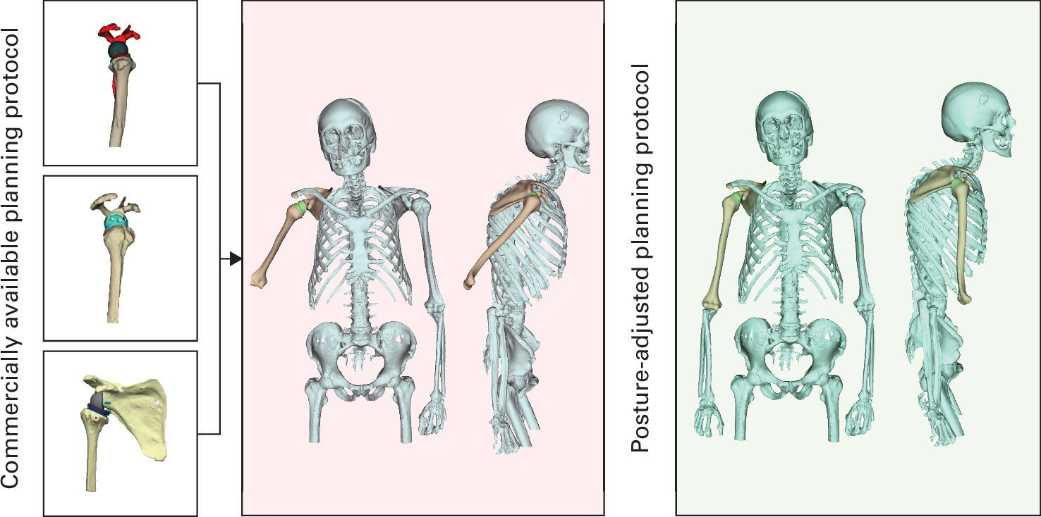 Fig. 4 
            Illustration of starting position of the humerus in a posture type C patient in three different types of commercially available planning software and a posture-adjusted software. In a standard software, the starting position is aligned with the scapula that is neutrally oriented in space. Therefore, considering the whole body and scapulothoracic orientation, the starting position of the humerus is incorrect. With a posture-adjusted software, a neutral starting position of the humerus can be achieved.
          