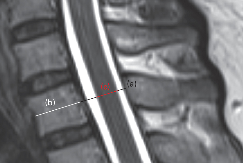 Fig. 2 
            Measurement on T2-weighted sagittal image: a) anteroposterior (AP) diameter of cervical spinal canal; b) mid-vertebral AP diameter of vertebral body; c) AP diameter of cervical spinal cord (measured on the same line for a)).
          