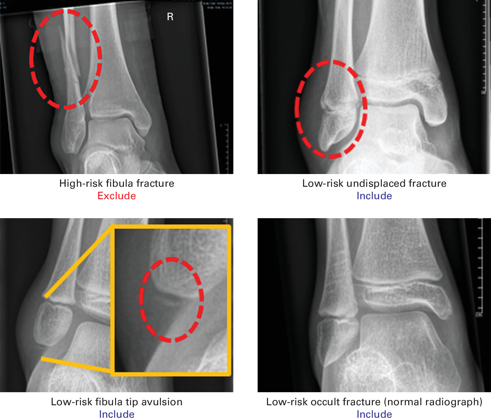 Fig. 1 
            Radiograph examples of eligible fracture patterns.
          