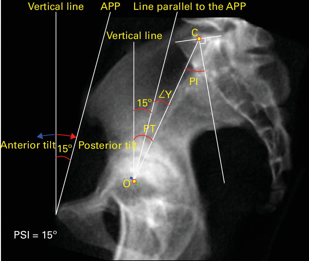 Fig. 1 
          The positional relationships of pelvic sagittal inclination (PSI), pelvic tilt (PT), ∠γ, and pelvic incidence (PI). ∠γ is defined as the angle between the line from the midpoint (O) of the bilateral femoral head to the midpoint of the sacral endplate (C) and the APP. PI is defined as the angle between the line connecting O to C and the vertical line of the sacral endplate.
        