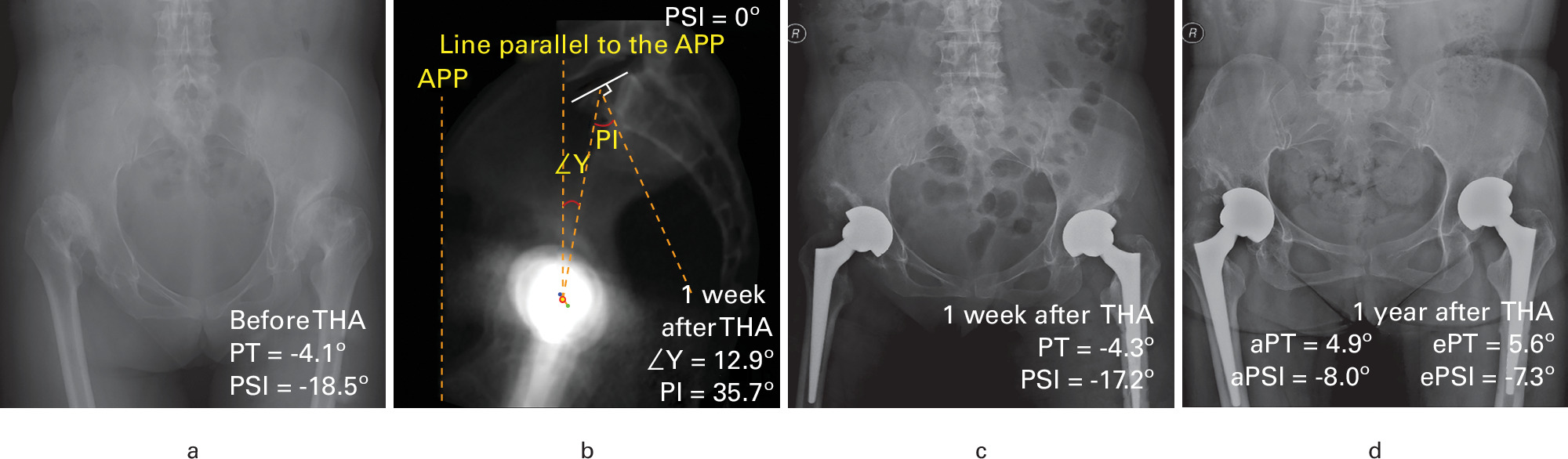 Fig. 3 
            Changes in pelvic sagittal parameters at different timepoints in a 58-year-old female patient. a) An anteroposterior pelvic radiograph taken before total hip arthroplasty (THA). b) A digitally reconstructed lateral radiograph showed the pelvic incidence (PI) and ∠γ one week after THA. c) Anteroposterior pelvic radiograph taken one week after THA. d) Anteroposterior pelvic radiograph taken one year after THA. The actual pelvic sagittal inclination (aPSI) and actual PT (aPT) represent the PT and PSI calculated by the inverse cosine function algorithm. The equational PT (ePT) was calculated by the equation PT = 0.45 × PI - 10.5°, and the ePSI was calculated by the equation: 0.45 × PI - 10.5° - ∠γ. With the PI measured at 35.7°, the calculated ePT was 5.6°, and with ∠γ at 12.9°, the calculated ePSI was -7.3°. Compared to one week post-THA, the aPSI of this patient increased by 9.2° at one year. APP, anterior pelvic plane.
          