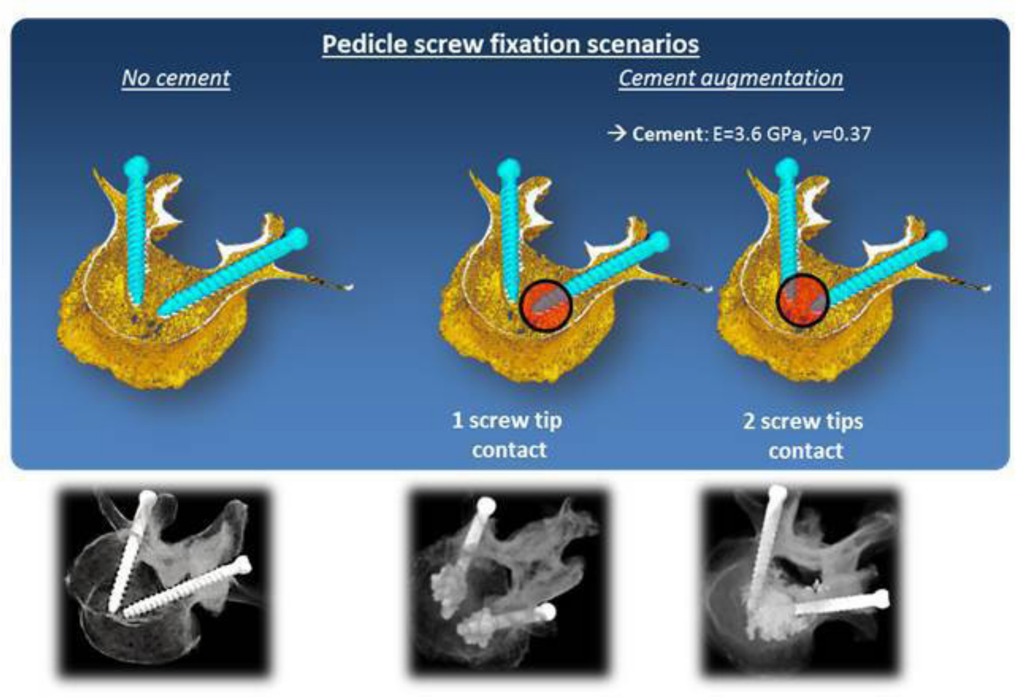 Fig. 2 
            The microfinite element models were used for testing cementing scenarios: non-augmented case; a case where cement zones were localized around each screw tip without contact; and a final case where cement zones were in contact with both screw tips.
          