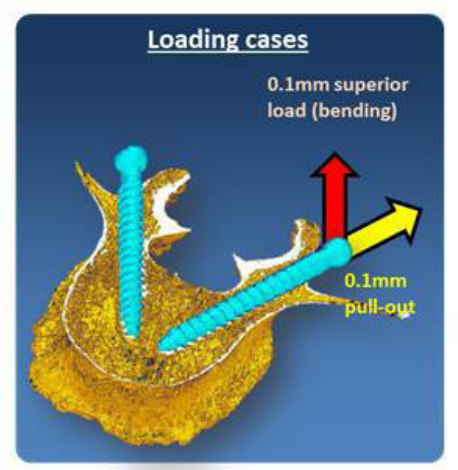 Fig. 3 
            Full vertebra microfinite element models were tested in axial pull-out and bending load for each screw.
          