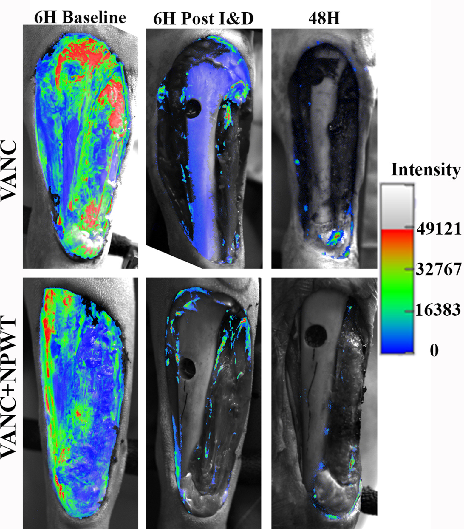 Fig. 1 
          Bacterial luminescent data represented as percentage of six-hour baseline (before irrigation and debridement (I&D)). There was no difference detected between groups at the 48-hour study endpoint (p = 0.986, generalized linear model adjusting for post I&D). NPWT, negative pressure wound therapy; VANC, vancomycin powder placed directly on wound; VANC+NPWT, vancomycin powder placed directly on wound with NPWT application.
        