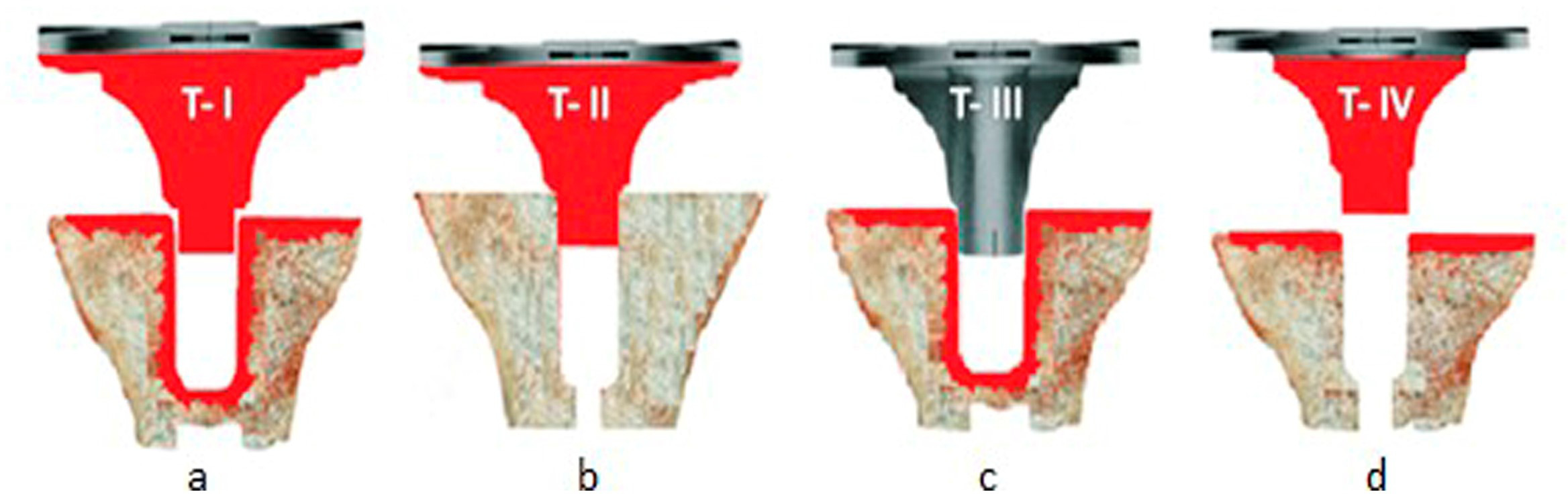 Fig. 1 
            a) Technique 1 – Double cementation with bone restrictor. b) Technique 2 – Metallic cementation without bone restrictor. c) Technique 3 – Bone cementation with bone restrictor. d) Mixed cementation, superficial bone, and metaphyseal metallic without bone restrictor.
          