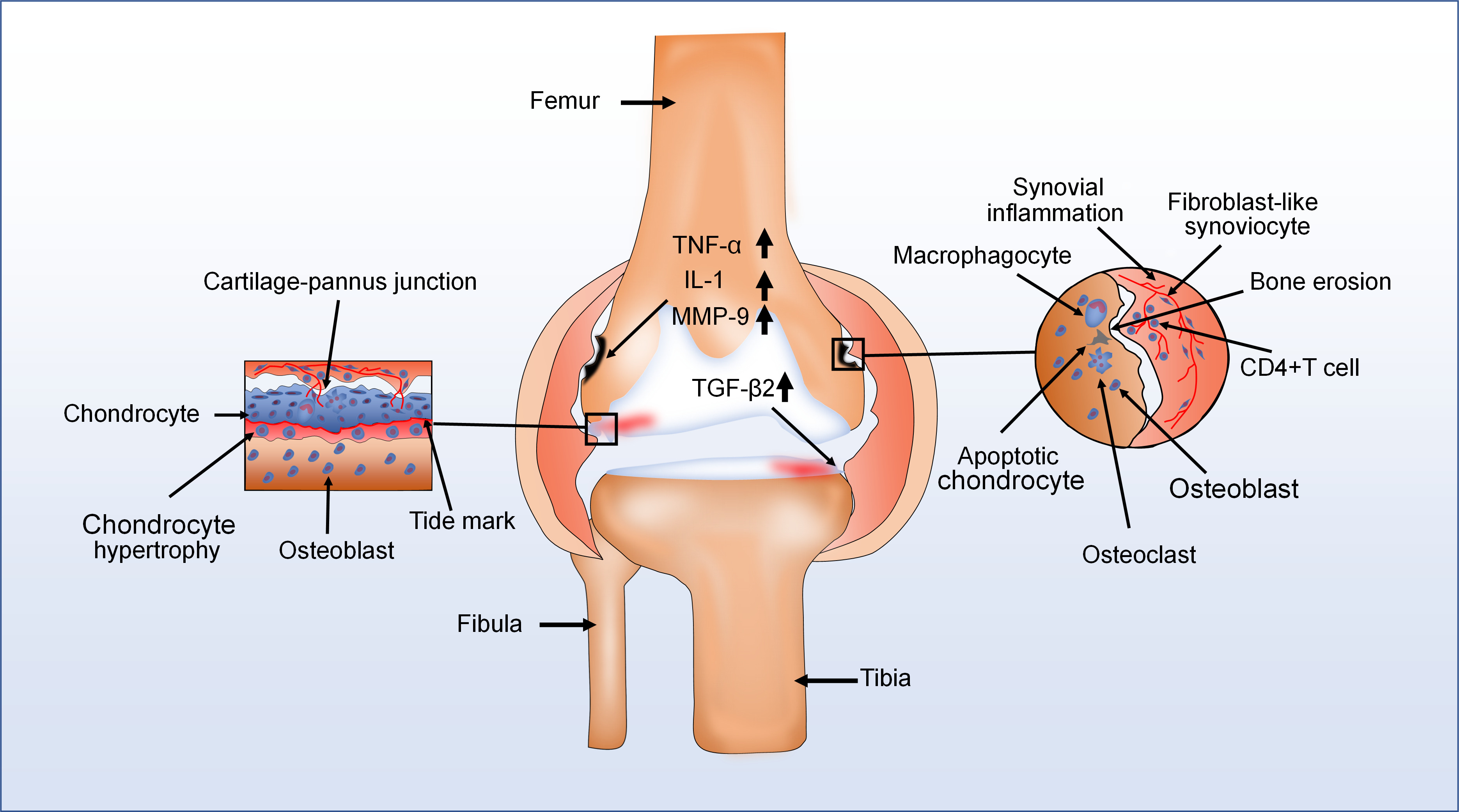 Fig. 5 
            The major pathological characteristics of rheumatoid arthritis (RA) are chronic synovitis with hyperplasia, pannus formation, and immune cell infiltration. For instance, in one diagram (left), various cell types in the cartilage-pannus of RA secrete lots of proinflammatory factors to induce cartilage damage and degradation of collagen. In another (right), there are also numerous immune cells infiltration and development of new blood vessels in the synovium of RA with hyperplasia, and the expression of transforming growth factor-beta2 (TGF-β2) also increases. Moreover, bone erosion appeared in the vicinity of the thickened synovium. CD4, cluster of differentiation 4; IL-1, interleukin 1; MMP, matrix metalloproteinase; TNF-α, tumour necrosis factor alpha.
          