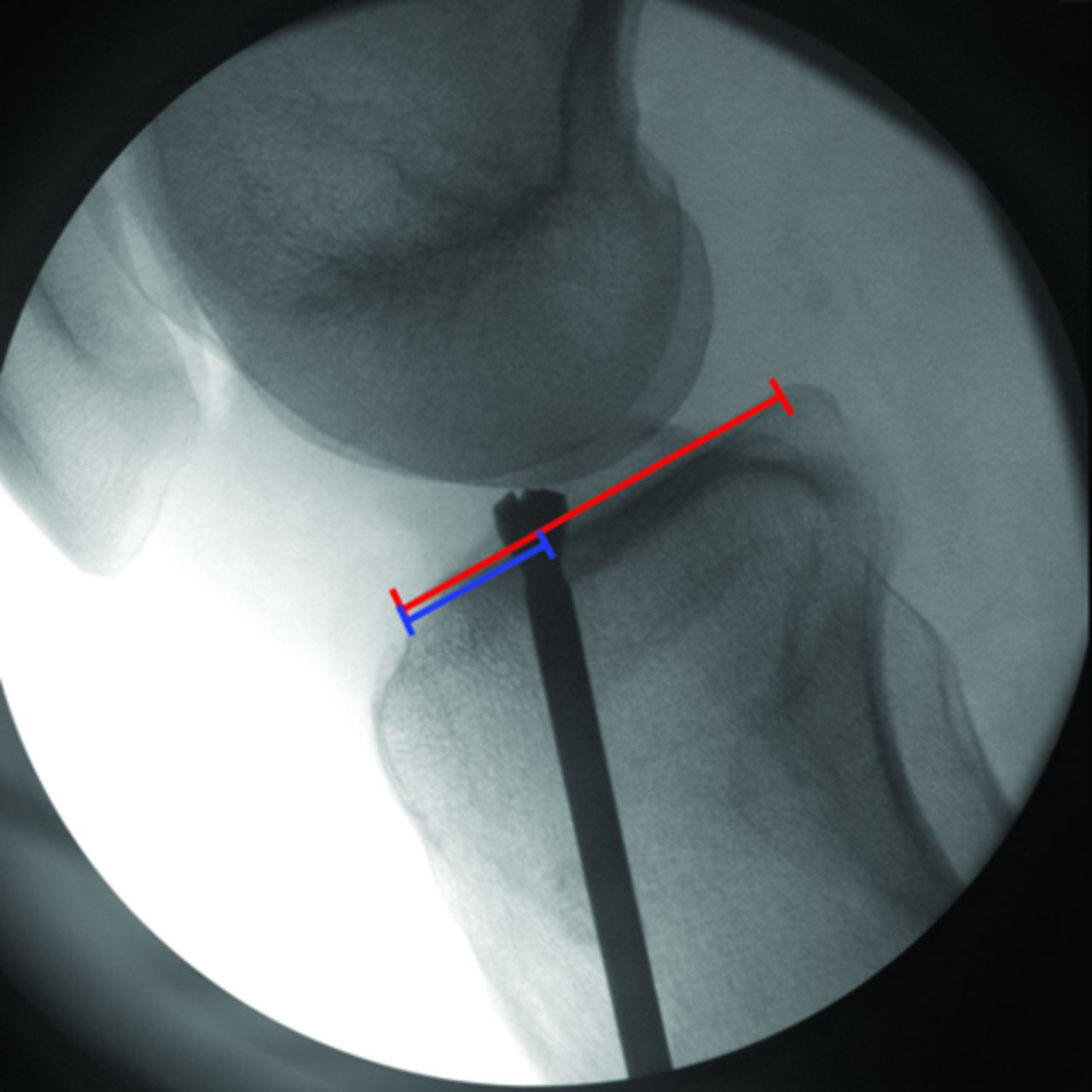 Figs. 1a - 1b 
          Intra-operative fluoroscopic
image (a) and post-operative radiograph (b) showing the interference
screw following the position of the reamer.
        