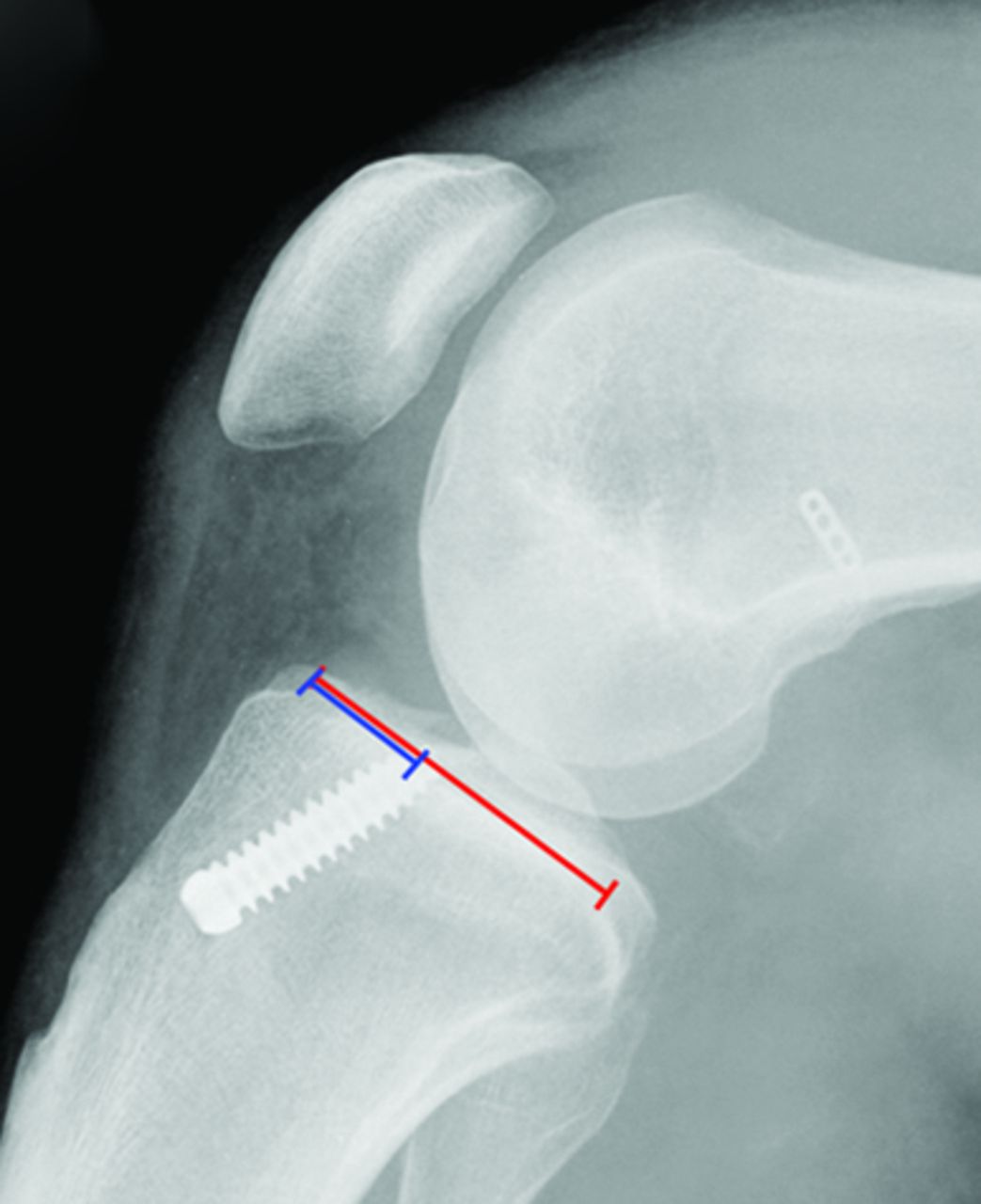 Figs. 1a - 1b 
          Intra-operative fluoroscopic
image (a) and post-operative radiograph (b) showing the interference
screw following the position of the reamer.
        