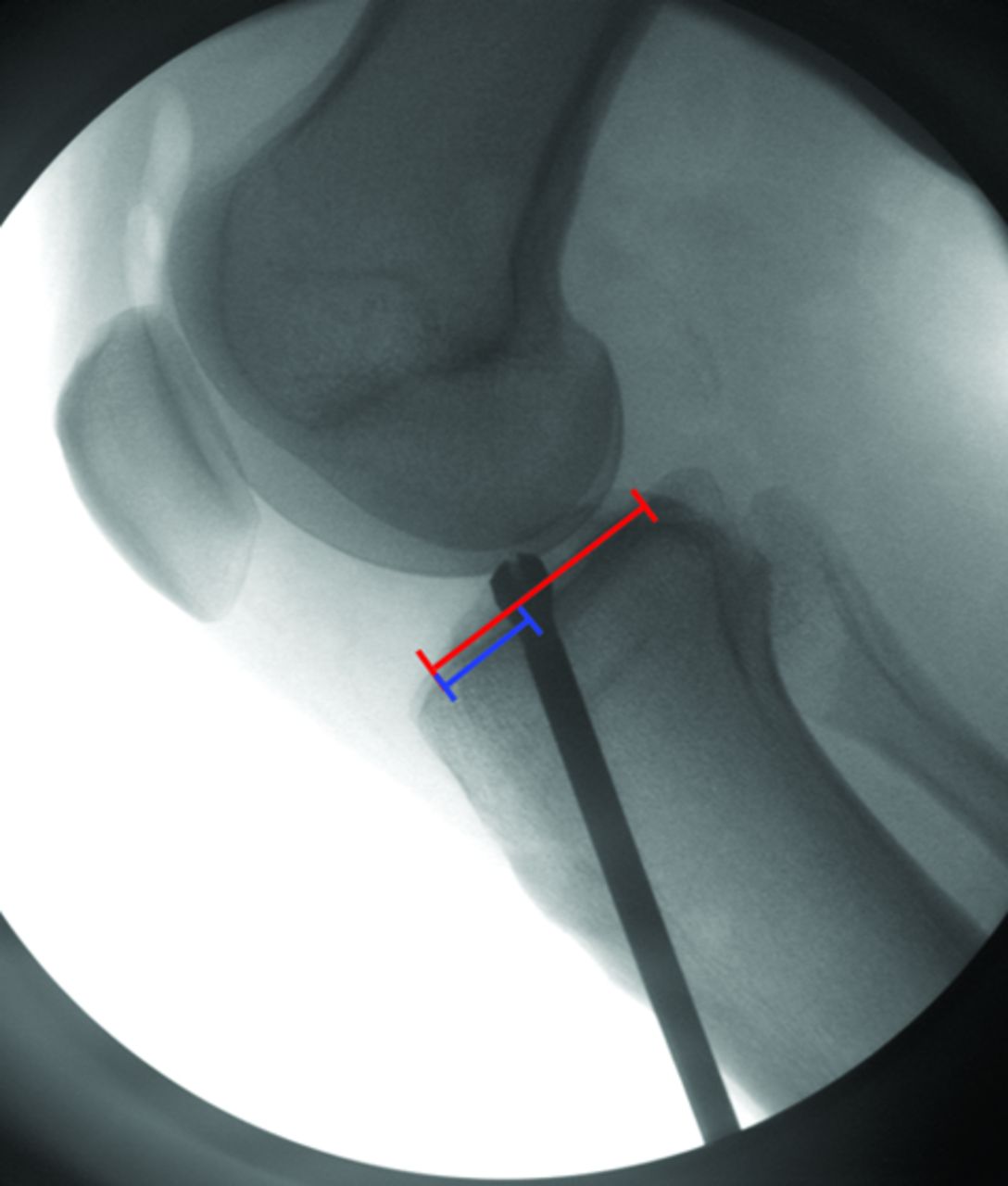 Figs. 2a - 2b 
          Intra-operative fluoroscopic image
(a) and post-operative radiograph (b) showing the interference screw
not following the position of the reamer.
        