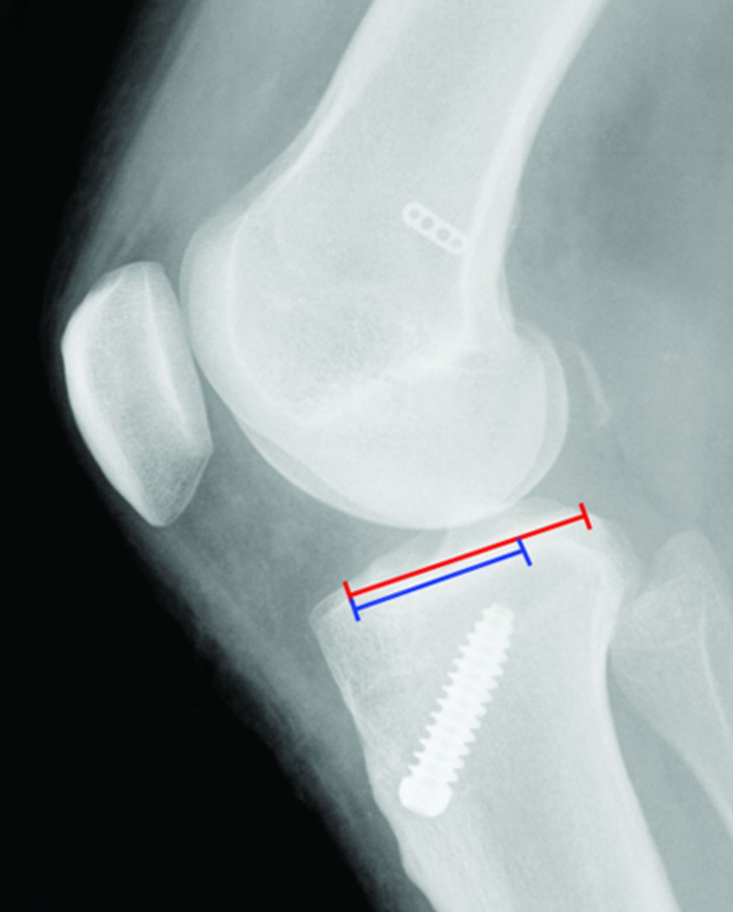 Figs. 2a - 2b 
          Intra-operative fluoroscopic image
(a) and post-operative radiograph (b) showing the interference screw
not following the position of the reamer.
        