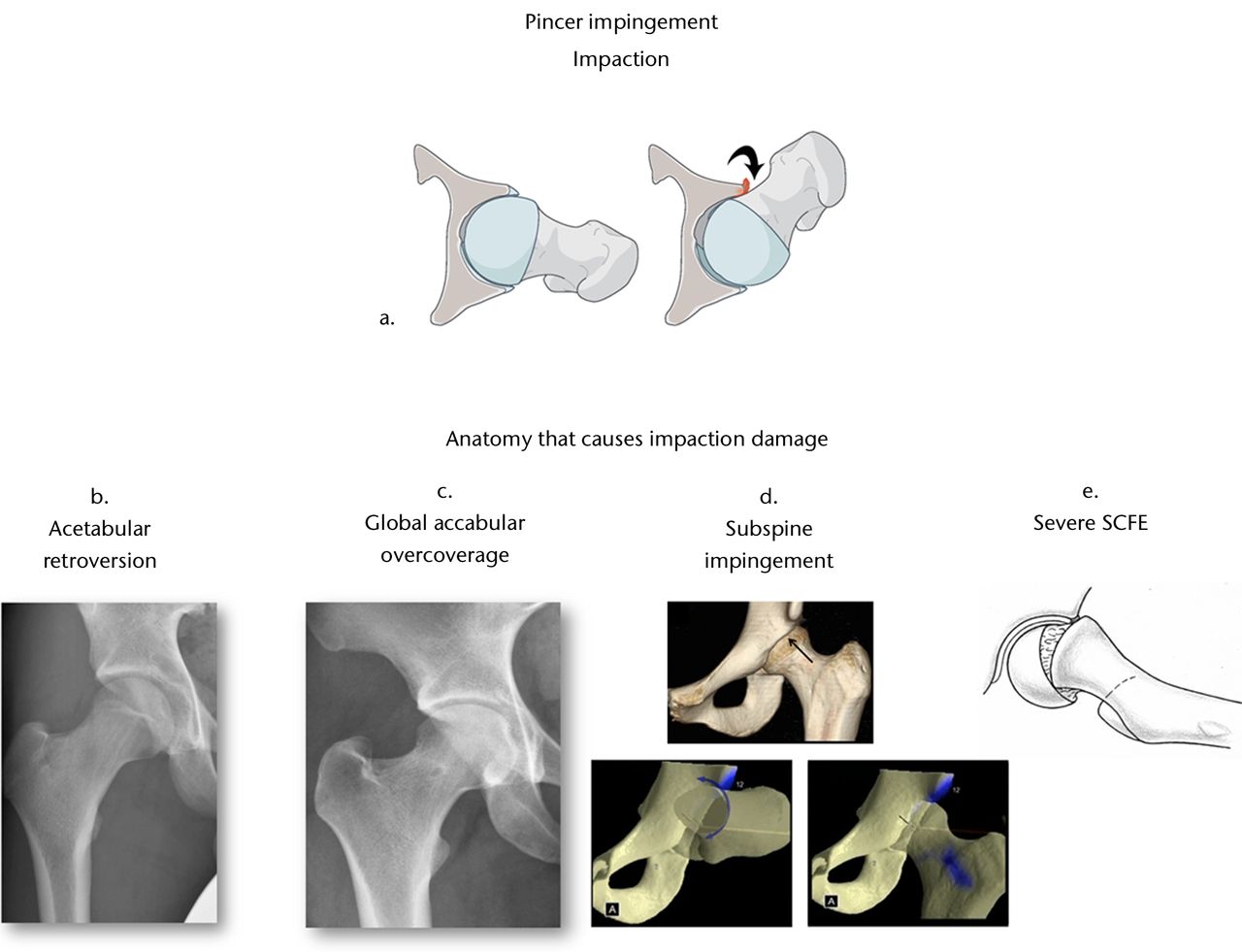 Fig. 2 
        Pincer impingement causes an impaction
injury (a).25 Global
or focal acetabular overcoverage causes the rim to contact the femoral
head, metaphysis or neck when the hip is flexed (curved arrow).
Anatomical deformities that can produce impaction-type injury include
acetabular retroversion (b), global acetabular overcoverage (c),
a large or prominent subspine (d)28 or severe slipped capital femoral
epiphysis (SCFE) (e). (Reprinted with permission: a) Leunig
et al. Femoroacetabular impingement: diagnosis and management,
including open surgical technique. Oper Tech Sports Med 2007;15:178–188.
d) Larson et al. Making a case for anterior inferior
iliac spine/subspine hip impingement: three representative case
reports and proposed concept. Arthroscopy 2011;27:1732–1737.
e) Leunig et al. Slipped capital femoral epiphysis:
early mechanical damage to the acetabular cartilage by a prominent
femoral metaphysis. Acta Orthop Scand 2000;71:370–375).
      