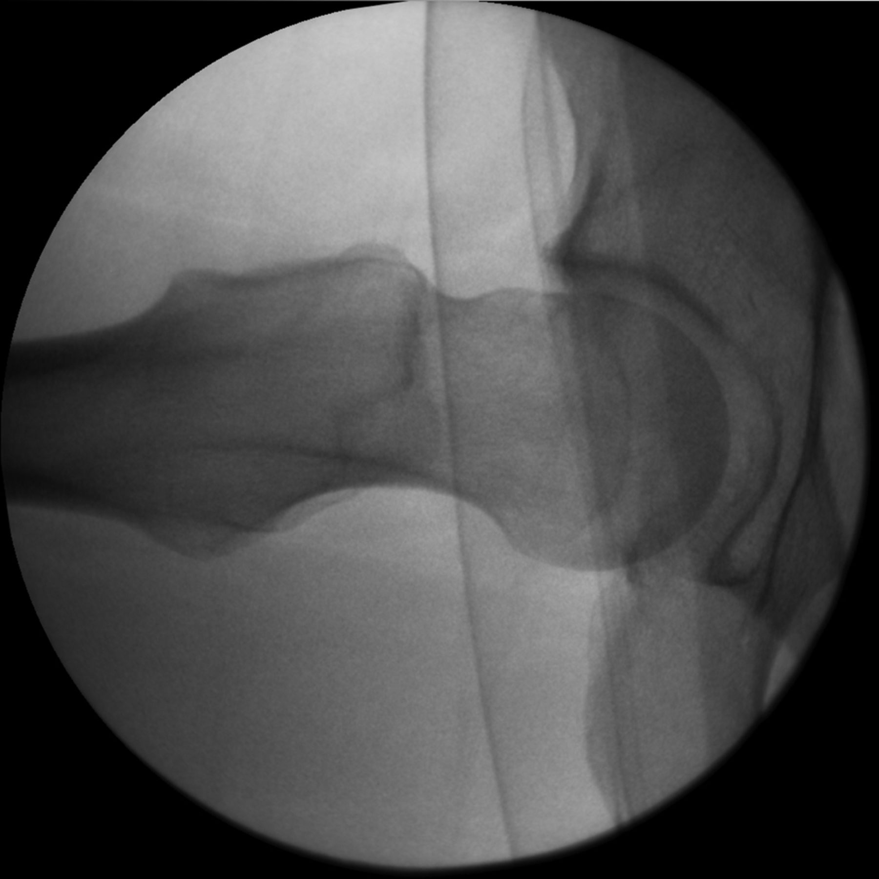 Figs. 7a - 7b 
            Fluoroscopic images showing dynamic
instability due to impingement. The patient has a large anterior
cam deformity, seen here on a lateral view with the leg in flexion
(a). As the leg is flexed further, the deformity contacts the rim
and causes levering of the head (b).
          