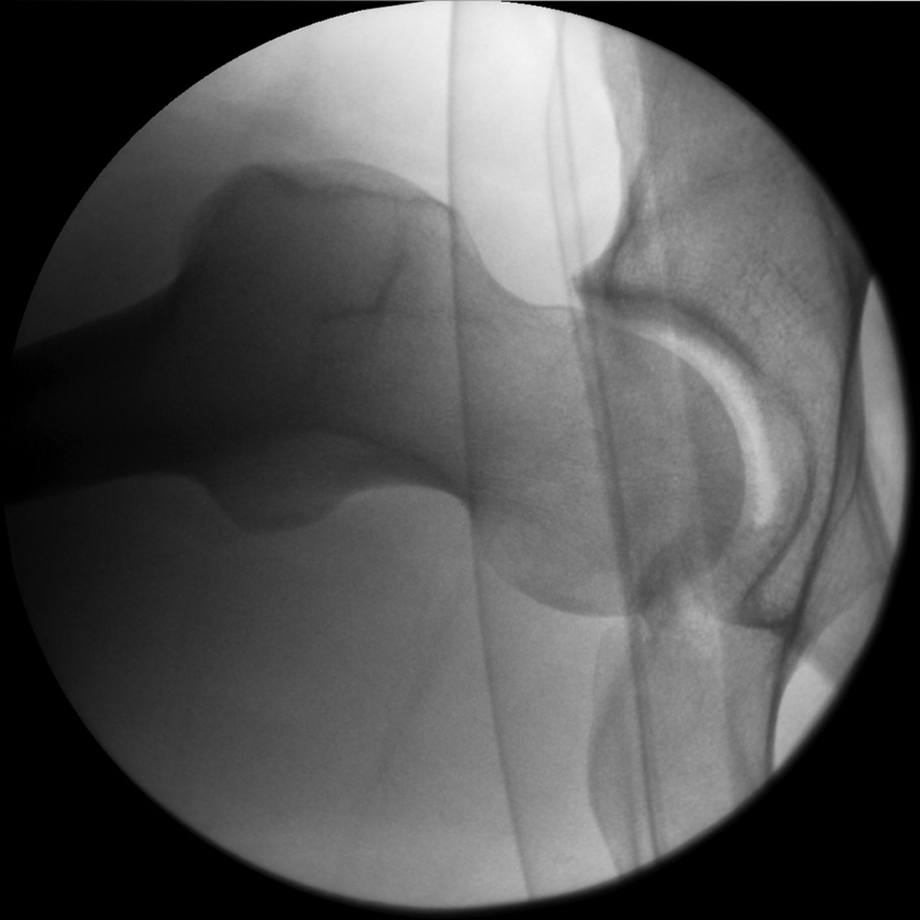 Figs. 7a - 7b 
            Fluoroscopic images showing dynamic
instability due to impingement. The patient has a large anterior
cam deformity, seen here on a lateral view with the leg in flexion
(a). As the leg is flexed further, the deformity contacts the rim
and causes levering of the head (b).
          