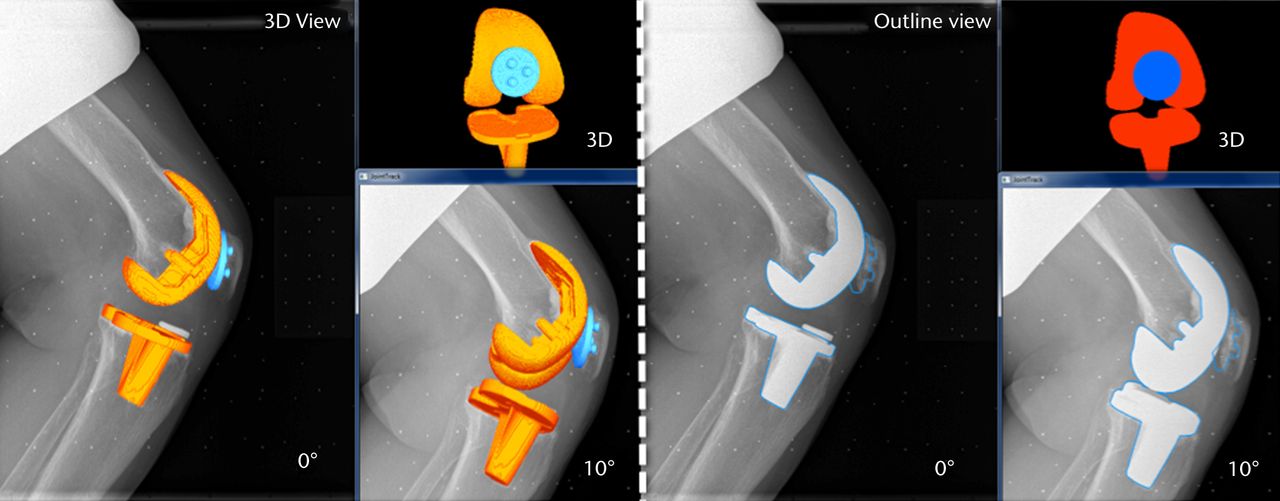 Figs. 5a - 5b 
            Images generated from the JointTrack
Biplane software in three-dimensional (3D) view and silhouette view
for a) the post-operative and b) the pre-operative knees.
          