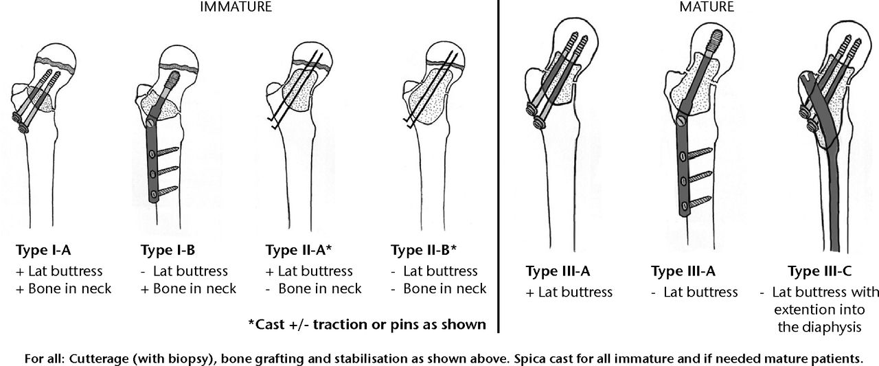 Fig. 2 
          Diagrams showing the classification
system for the treatment of pathological fractures of the proximal
femur associated with bone cysts in children (adapted with permission
from Dormans JP, Pill SG. Fractures through bone cysts:
unicameral bone cysts, aneurysmal bone cysts, fibrous cortical defects,
and nonossifying fibromas. Instr Course Lect 2002;51:457–467).
        