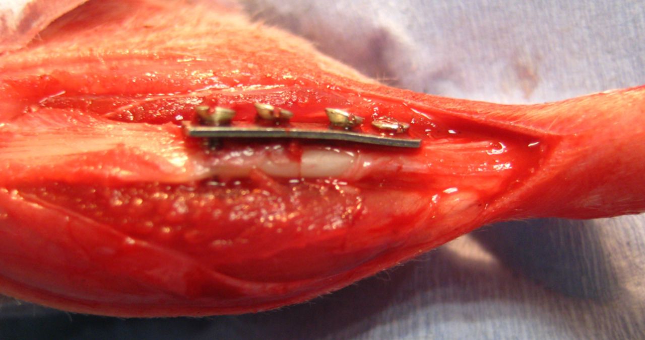 Fig. 2 
            Intra-operative photograph of tibial
plating, showing anatomical alignment and compression at the osteotomy
site.
          