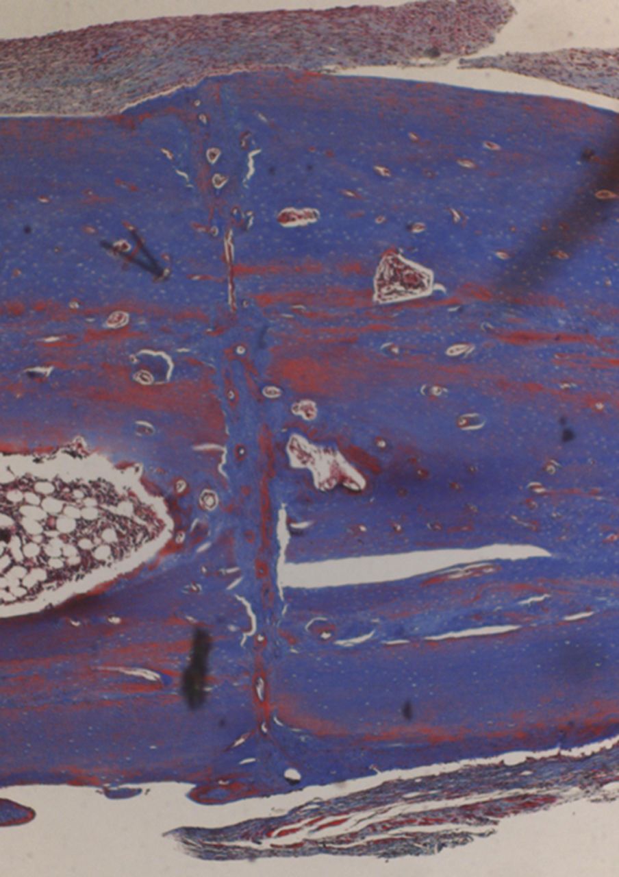 Figs. 4a - 4d 
            Histological images of Masson’s
trichrome stained sections taken from specimens treated with plate
fixation, showing a) the anterior section, b) the middle section
and c) the posterior section (yellow box shows area magnified in
Figure 4d) (all original magnification ×4). The osteotomy fragments
are aligned with no external callus. On the upper aspect note ‘contact
healing’ on the cortical surface of plate application and ‘gap healing’
on the lower cortex opposite plate application, best seen on middle section
(b). Figure 4d – histological image at original magnification ×20,
with the arrow showing the ‘cutting cone’ traversing the fracture site.
          