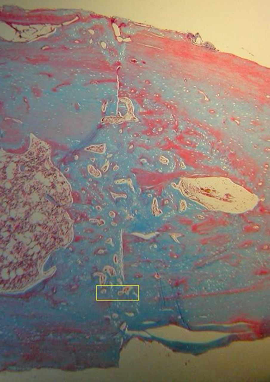 Figs. 4a - 4d 
            Histological images of Masson’s
trichrome stained sections taken from specimens treated with plate
fixation, showing a) the anterior section, b) the middle section
and c) the posterior section (yellow box shows area magnified in
Figure 4d) (all original magnification ×4). The osteotomy fragments
are aligned with no external callus. On the upper aspect note ‘contact
healing’ on the cortical surface of plate application and ‘gap healing’
on the lower cortex opposite plate application, best seen on middle section
(b). Figure 4d – histological image at original magnification ×20,
with the arrow showing the ‘cutting cone’ traversing the fracture site.
          