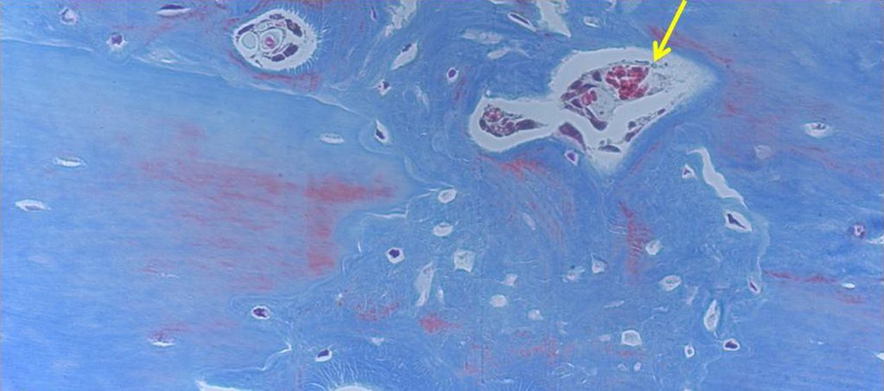 Figs. 4a - 4d 
            Histological images of Masson’s
trichrome stained sections taken from specimens treated with plate
fixation, showing a) the anterior section, b) the middle section
and c) the posterior section (yellow box shows area magnified in
Figure 4d) (all original magnification ×4). The osteotomy fragments
are aligned with no external callus. On the upper aspect note ‘contact
healing’ on the cortical surface of plate application and ‘gap healing’
on the lower cortex opposite plate application, best seen on middle section
(b). Figure 4d – histological image at original magnification ×20,
with the arrow showing the ‘cutting cone’ traversing the fracture site.
          