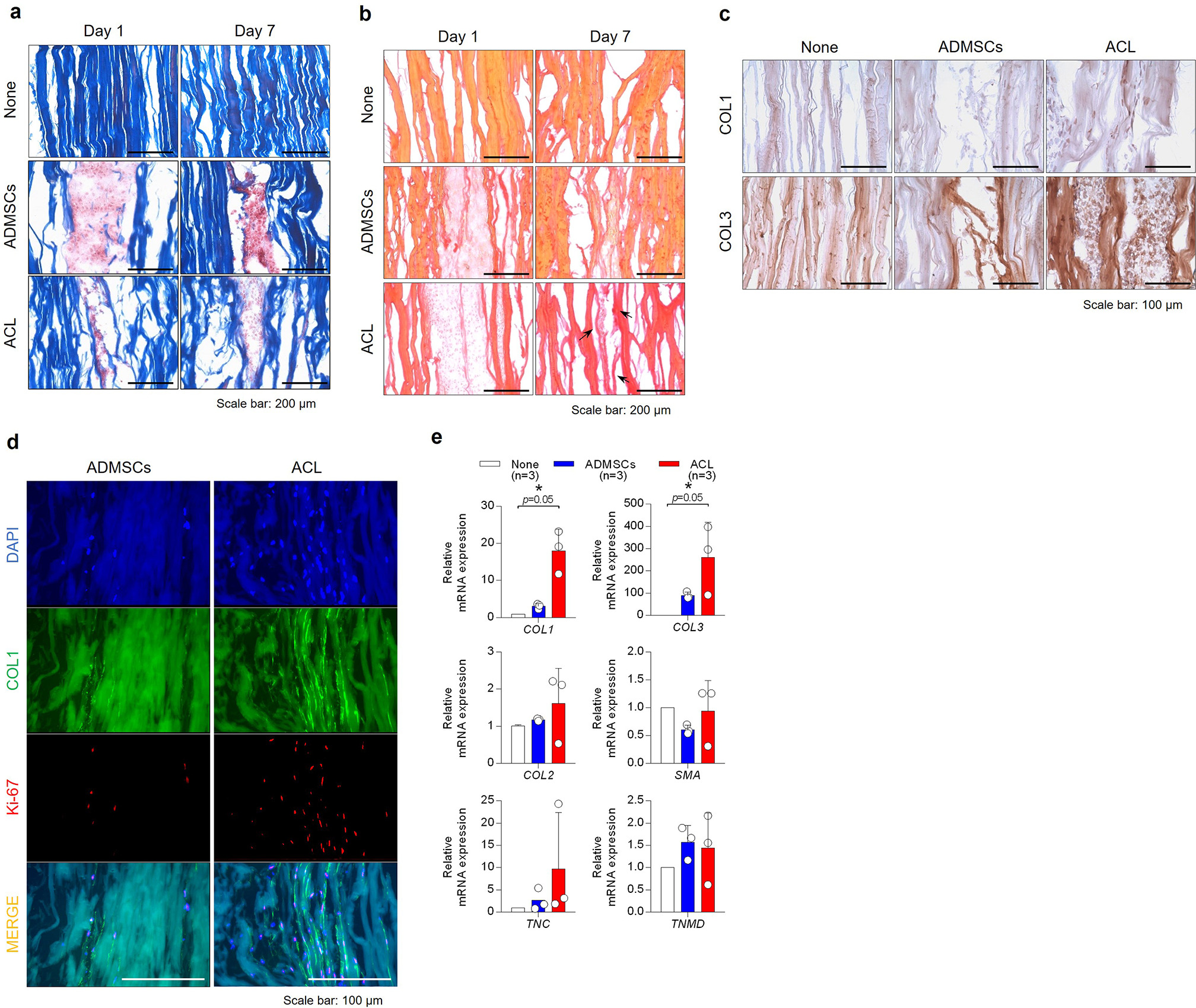 Fig. 3 
            Tendon allograft injected with anterior cruciate ligament (ACL)-derived cells, or adipose-derived mesenchymal stem cells (ADMSCs) was stained and observed by a) Masson’s trichrome staining for total collagen and b) Sirius Red staining for collagen types I and III. Magnification ×200, scale bar 200 µm. c) Immunohistochemical staining of the tendon allograft reseeded with ACL-derived cells or ADMSCs was conducted at seven days for type I collagen (upper) and type III collagen (lower). Magnification ×200, scale bar 100 µm. d) Immunofluorescence of the tendon allograft injected with ACL-derived cells or ADMSCs was conducted at day 7 for Ki-67 (red) and type I collagen (green). e) mRNA expression of ligament-specific markers (COL1, COL3, tenascin C (TNC), and tenomodulin (TNMD)), chondrogenic marker (COL2), and smooth muscle actin (SMA) was analyzed by quantitative reverse transcription polymerase chain reaction (n = 3). DAPI, 4′,6-diamidino-2-phenylindole; mRNA, messenger RNA.
          