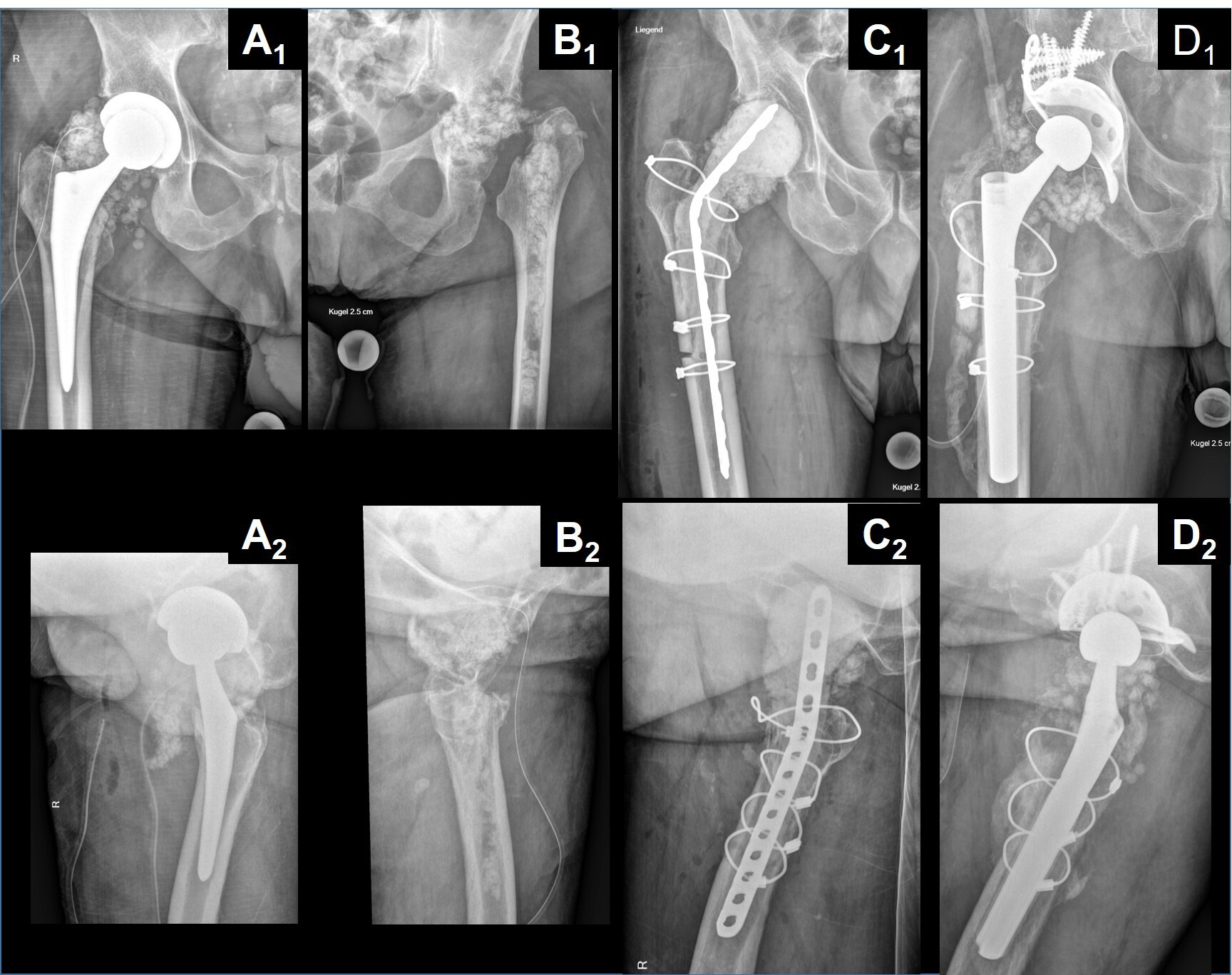 Fig. 1 
          Examples of applications of ceftriaxone-loaded calcium sulphate (CaSO4). Ceftriaxone concentrations were measured in wound fluid in each of these patients. Note that in all cases the CaSO4 pellets were packed in the hip wound cavity or around the proximal femur. Even if the procedures differed, soft-tissue exposure and dissolution of the pellets were similar. Anteroposterior views of the affected hip are provided In the upper row, and corresponding axial views are provided in the lower row. All images correspond to postoperative radiographs. a) After debridement, antibiotics and implant retention (DAIR) procedure in the case of periprosthetic joint infection (PJI) after primary total hip arthroplasty (THA) in a 69-year-old male. b) After the first stage of a two-stage exchange without spacer in the case of PJI after primary THA in a 70-year-old female. c) After the first stage of a two-stage exchange with spacer in the case of PJI after primary hemiarthroplasty in a 71-year-old male. d) After a DAIR procedure as salvage in the case of PJI recurrence after a two-stage exchange in a 66-year-old male.
        