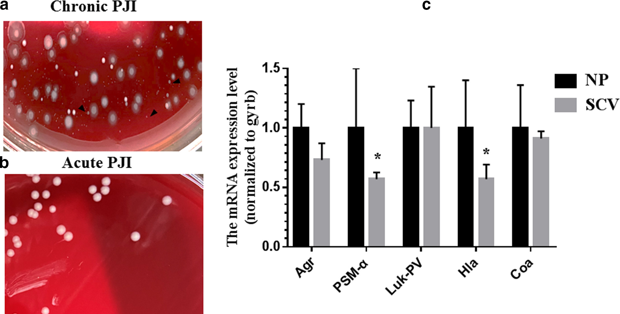 Fig. 1 
            a) and b) Colony morphologies of acute and chronic periprosthetic joint infection (PJI) microbial cultures: small colony variants (SCVs) could be isolated from chronic PJI cultures (indicated by black arrows). c) Expression levels of virulence factors in Staphylococcus aureus normal phenotype (NP) and SCVs. *p < 0.05. Agr, accessory gene regulator; Coa, coagulase; gyrb: gyrase subunit B; Hla, α-haemolysin; Luk-PV, Panton-Valentine leukocidin; mRNA, messenger RNA; PSM-α, phenol-soluble modulin-α.
          