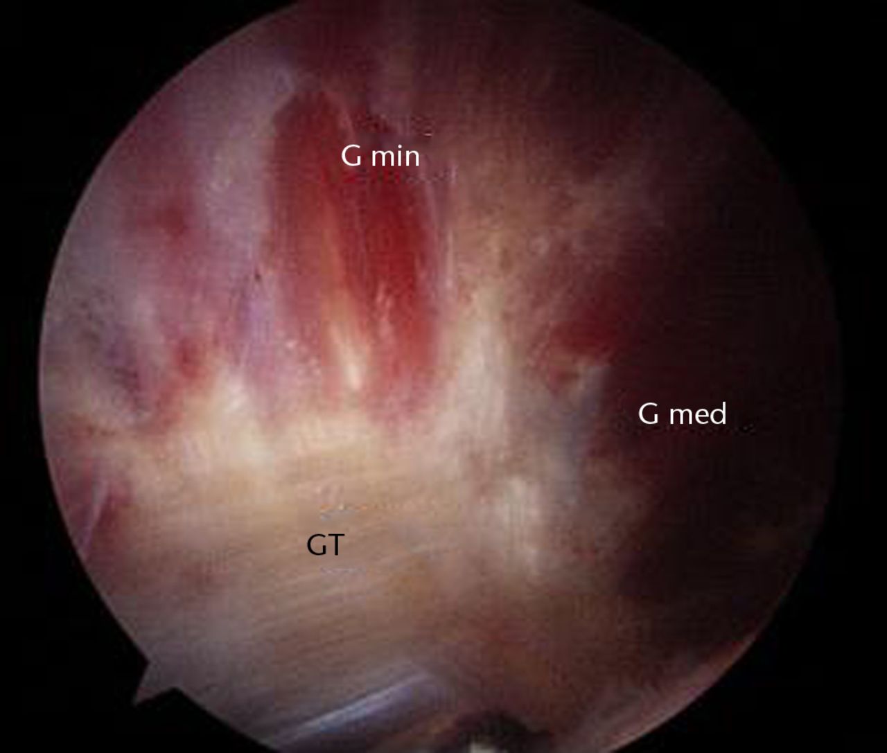 Fig. 1 
          Endoscopic anatomy of the peritrochanteric
space (GT, greater trochanter; G med, gluteus medius; G min, gluteus
minimus).
        