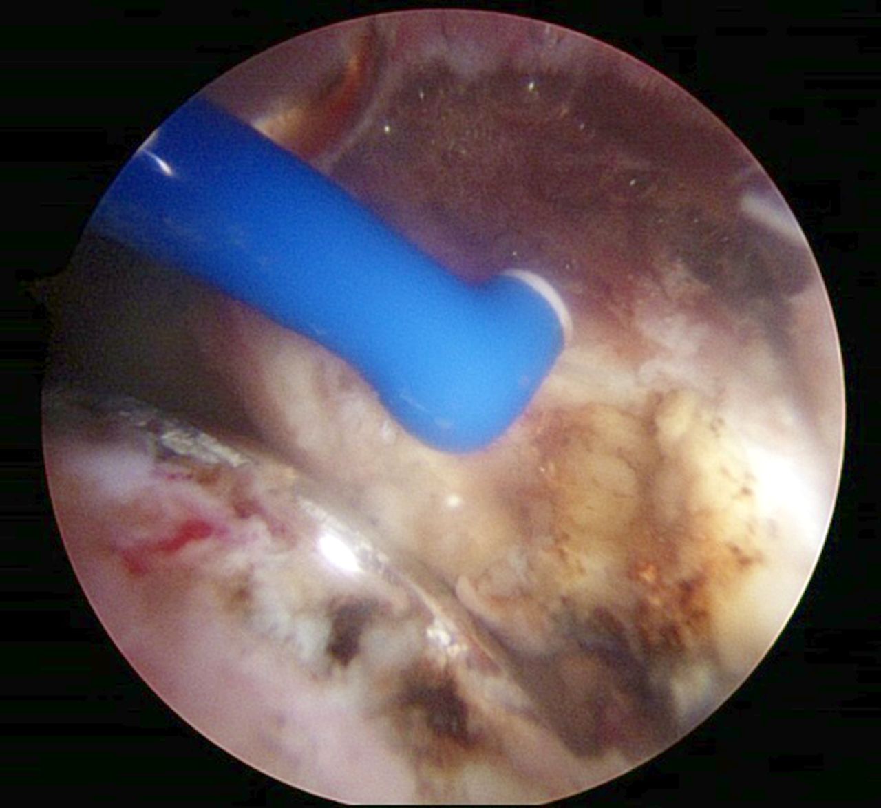 Figs. 4a - 4b 
          Arthroscopic psoas release for iliopsoas
impingement after a) total and b) resurfacing hip replacement.
        