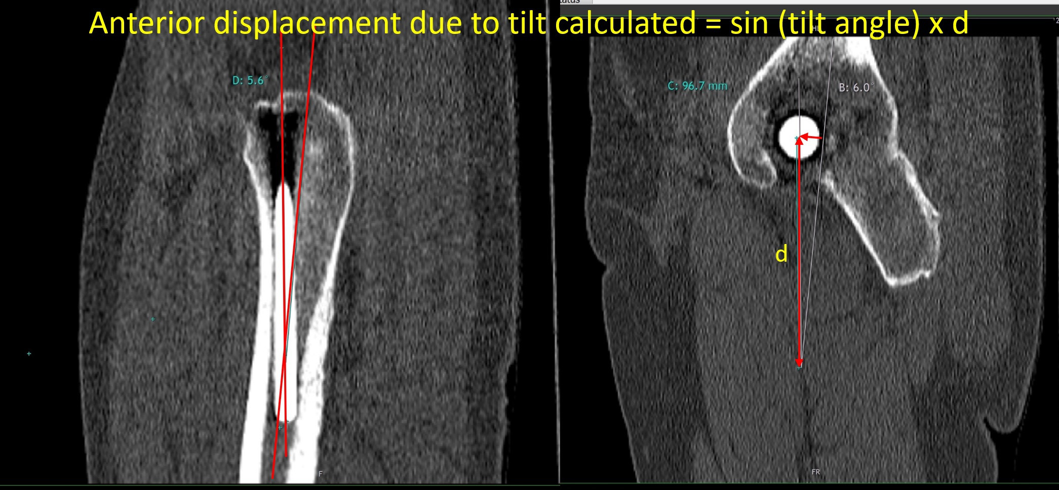 Fig. 3 
            Diagram of sagittal CT slices used to measure sagittal tilt of femoral stem and the resulting anterior displacement of the femoral head; "d" is the distance from the centre of the femoral head to the intersection of the stem axis and proximal femoral axis.
          