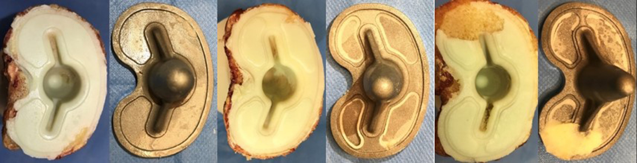 Fig. 10 
            Left: Group A (Attune). Centre: Group S (Attune S+) without adherent cement. Right: Group S with adherent cement.
          