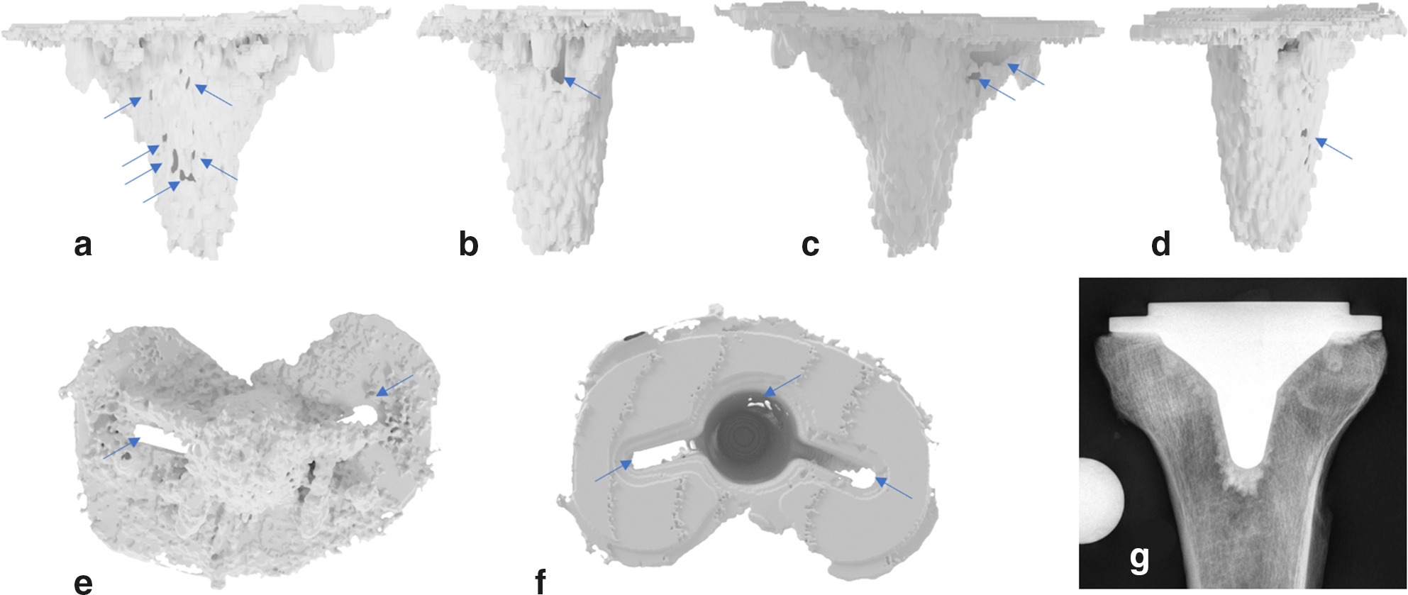 Fig. 6 
            CT scans with different views and blue arrows to mark the cement mantle defects. a) Anterior, b) lateral, c) posterior, d) medial, e) caudal, and f) cranial. g) The corresponding radiograph in anteroposterior projection without visible cement mantle defect.
          