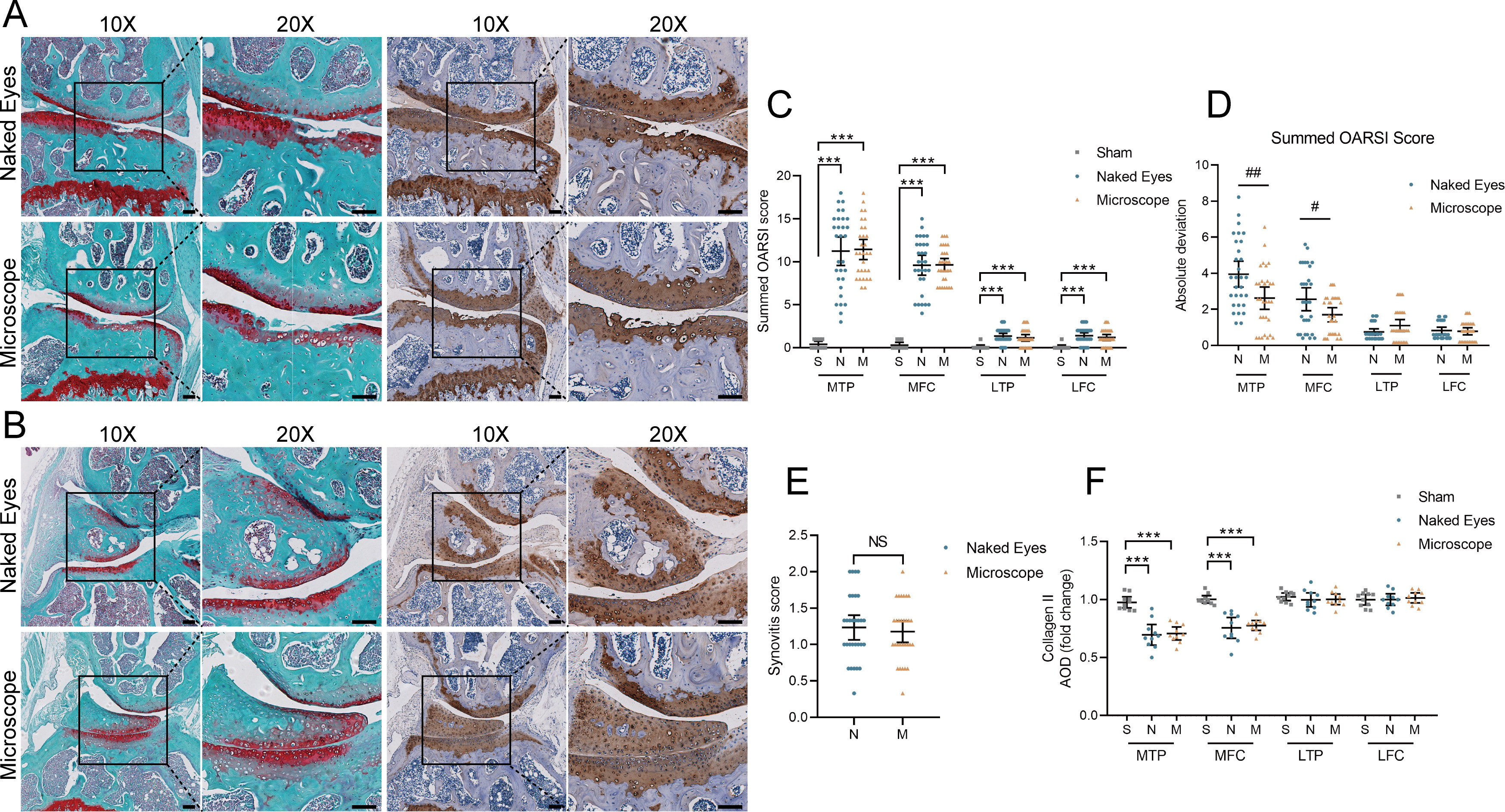 Fig. 4 
            Histological evaluation of surgical destabilization of the medial meniscus (DMM)-induced osteoarthritis (OA). a) and b) Representative images of Safranin O/Fast green staining (left panels) and diaminobenzidine (DAB)-visualized collagen type II immunohistochemical staining (right panels) of right knee frontal sections from naked-eye (upper rows) and microscope (lower rows) groups at 16 weeks after DMM surgery (A: MTP and MFC; B: LTP and LFC; scale bar, 100 μm). c) Quantitation of summed Osteoarthritis Research Society International (OARSI) scoring for histological evaluation at 16 weeks. Mean OARSI scores of four analysis quadrants for microscope (M; n = 30), naked-eye (N; n = 30), and sham-operated (S; n = 10) groups are plotted. d) ADs of the summed OARSI scores for M and N groups. e) Mean scores for synovial tissue inflammation of joint capsule. f) Average optical density (AOD) quantification of collagen type II immunostaining (n = 10). Data are expressed as means with 95% confidence intervals (CIs). Statistical analysis was performed using independent-samples t-test. ***p < 0.001 in comparison to the S group; #p < 0.05 and ##p < 0.001 in comparison to the N group. LFC, lateral femoral condyle; LTP, lateral tibial plateau; MFC, medial femoral condyle; MTP, medial tibial plateau; NS, no significance.
          