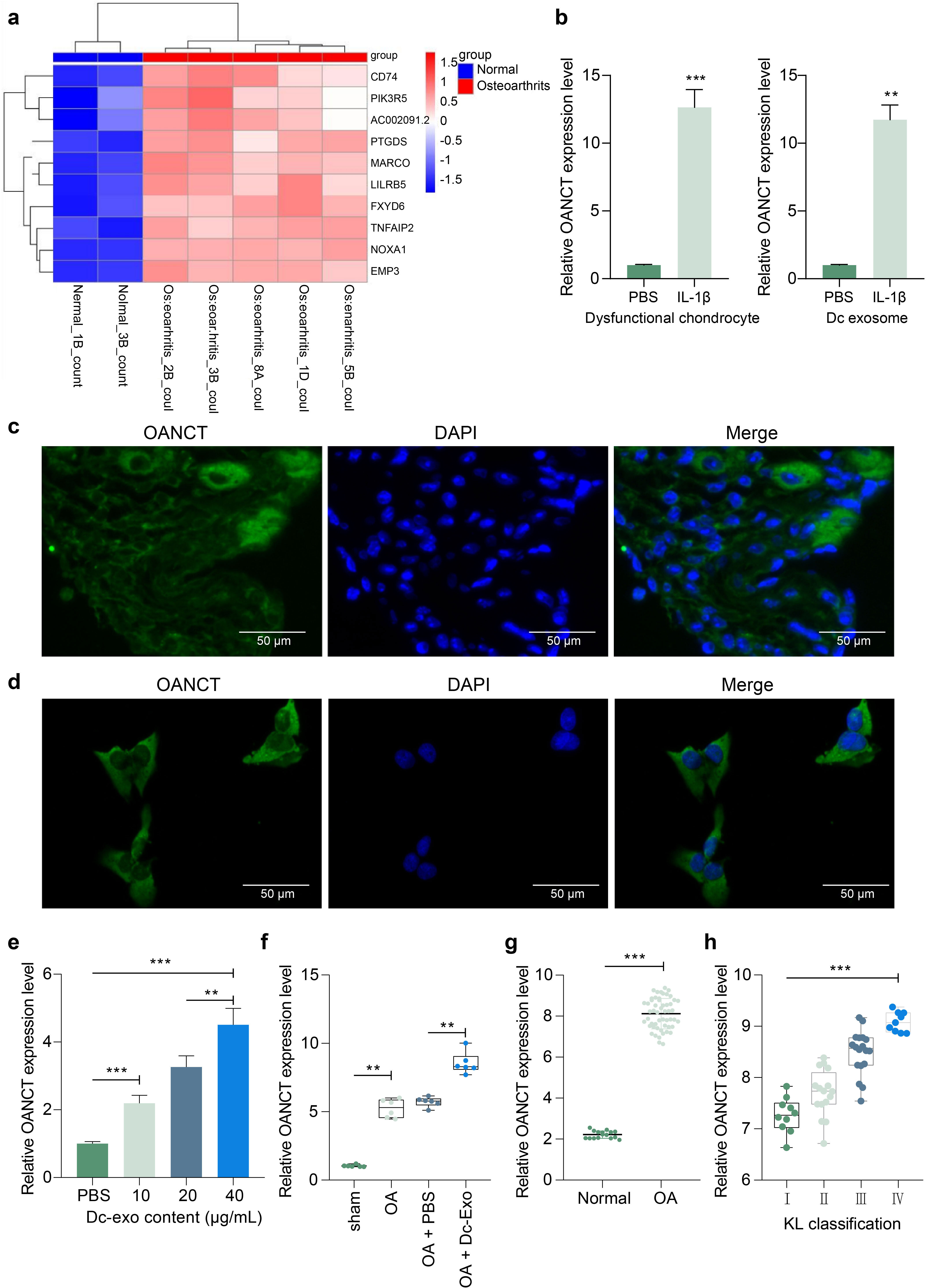 Fig. 3 
            The expression of osteoarthritis non-coding transcript (OANCT) is significantly increased in dysfunctional chondrocyte-derived exosomes (DC-exo). a) Heatmap of microarray screening of exosome from normal chondrocytes and interleukin beta (IL-1β)-treated chondrocytes. b) OANCT expression in chondrocytes and their exosomes detected by reverse transcription-quantitative polymerase chain reaction (RT-qPCR). c) Fluorescence in situ hybridization (FISH) assay to detect the expression and distribution of OANCT in cartilage tissues or d) chondrocytes. e) RT-qPCR for OANCT expression in exosome-treated macrophages or f) rat cartilage tissues. g) RT-qPCR detection of OANCT expression in knee tissues from 53 osteoarthritis (OA) patients and 16 non-OA patients requiring meniscal arthroplasty due to fracture injury. h) Spearman correlation analysis of the correlation between the expression of OANCT and the patients’ Kellgren-Lawrence (KL) grade in 53 patients with OA. Each group contains six rats, with each dot representing one rat. The results are representative of three independent experiments. All data are represented as mean and standard deviation and analyzed using independent-samples t-test, and one-way analysis of variance with Tukey’s post-test. **p < 0.01, ***p < 0.001. DAPI, 4′,6-diamidino-2-phenylindole; EMP3, epithelial membrane protein 3; FXYD6, FXYD domain containing ion transport regulator 6; LILRB5, leucocyte immunoglobulin like receptor B5; MARCO, macrophage receptor with collagenous structure; NOXA1, NADPH oxidase activator 1; PBS, phosphate-buffered saline; PIK3R5, phosphoinositide-3-kinase regulatory subunit 5; PTGDS, prostaglandin D2 synthase; TNFAIP2, TNF alpha induced protein 2.
          