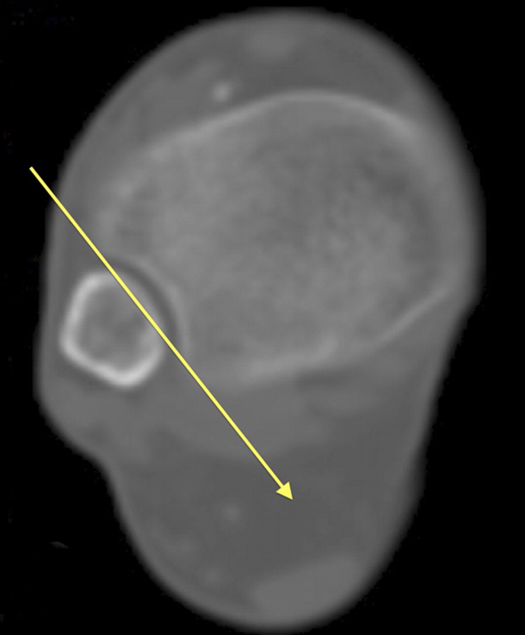 Figs. 3a - 3c 
          
            Figures 3a and 3b – axial CT
views a) in a patient with overlap between the distal tibia and
fibula, showing that a plain film x-ray beam (represented by the
yellow arrow) cannot be passed between the bones, and b) in a patient
without overlap, with the x-ray beam (yellow line) able to pass
between the tibia and fibula. Figure 3c – three-dimensional image
of the patient in Figure 3b, reconstructed from CT scans. This image
resembles a radiograph and can be rotated through 360° using GE
Workstation software (GE Healthcare).
        