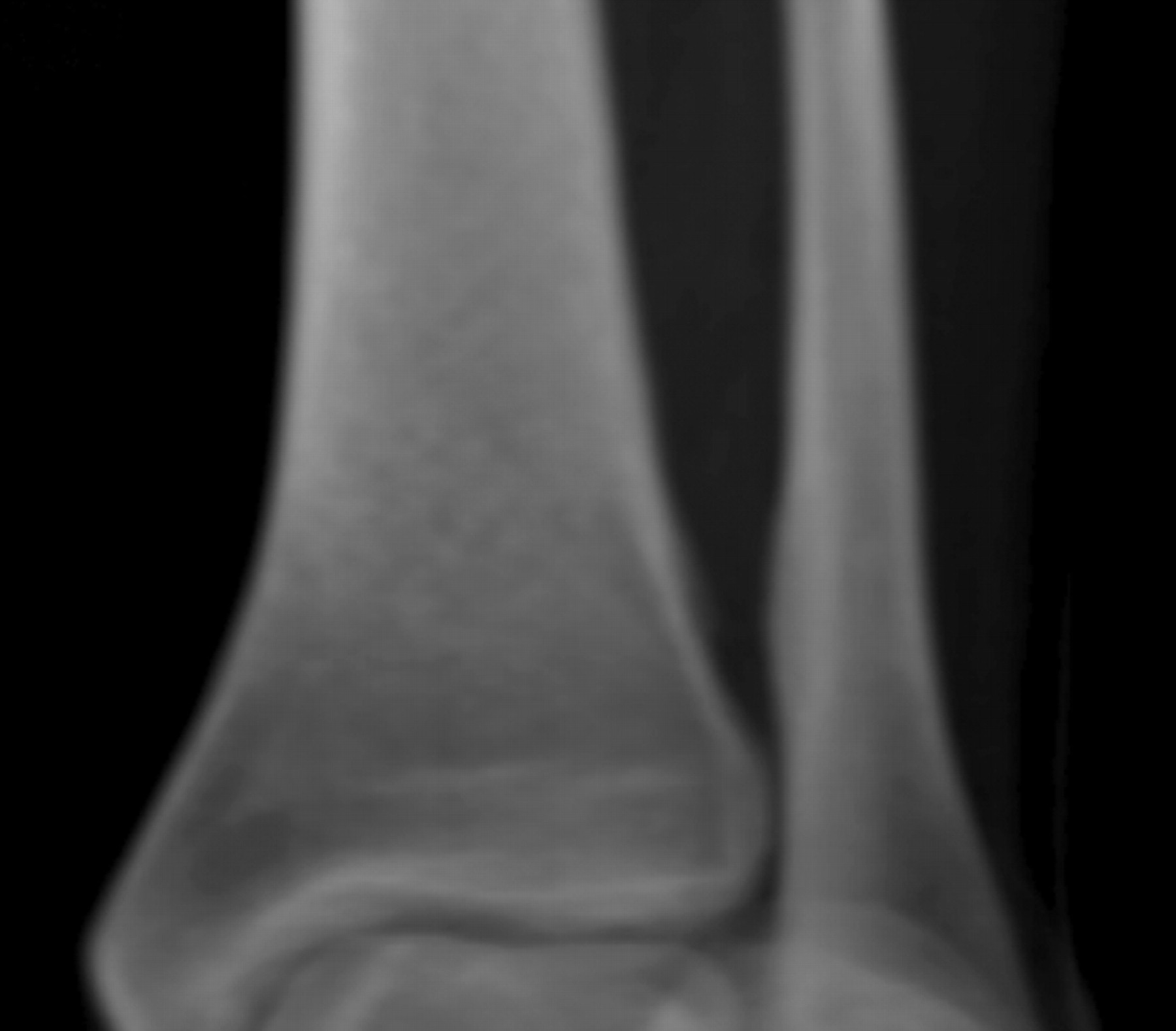 Figs. 3a - 3c 
          
            Figures 3a and 3b – axial CT
views a) in a patient with overlap between the distal tibia and
fibula, showing that a plain film x-ray beam (represented by the
yellow arrow) cannot be passed between the bones, and b) in a patient
without overlap, with the x-ray beam (yellow line) able to pass
between the tibia and fibula. Figure 3c – three-dimensional image
of the patient in Figure 3b, reconstructed from CT scans. This image
resembles a radiograph and can be rotated through 360° using GE
Workstation software (GE Healthcare).
        