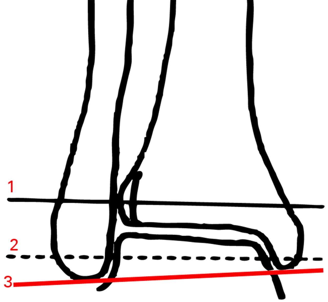 Figs. 4a - 4c 
          
            Figure 4a – diagram of a mortise
view showing approximate levels of axial slices shown in the diagrams in
Figures 4b and 4c. Line 1 is represented by solid lines and Line
2 represented by dotted lines in Figures 4b and 4c. Line 3 is the
line between the tips of the medial and lateral malleoli (intermalleoli
line). Figures 4b and 4c – diagrams of superimposed axial slices
for b) measurement of the angle (ABC) between the diastasis (AB)
and the intermalleoli axis (BC), and c) measurement of the angle
(ABC) between the diastasis (AB) and the talus (BC) (MM, medial
malleolus).
        