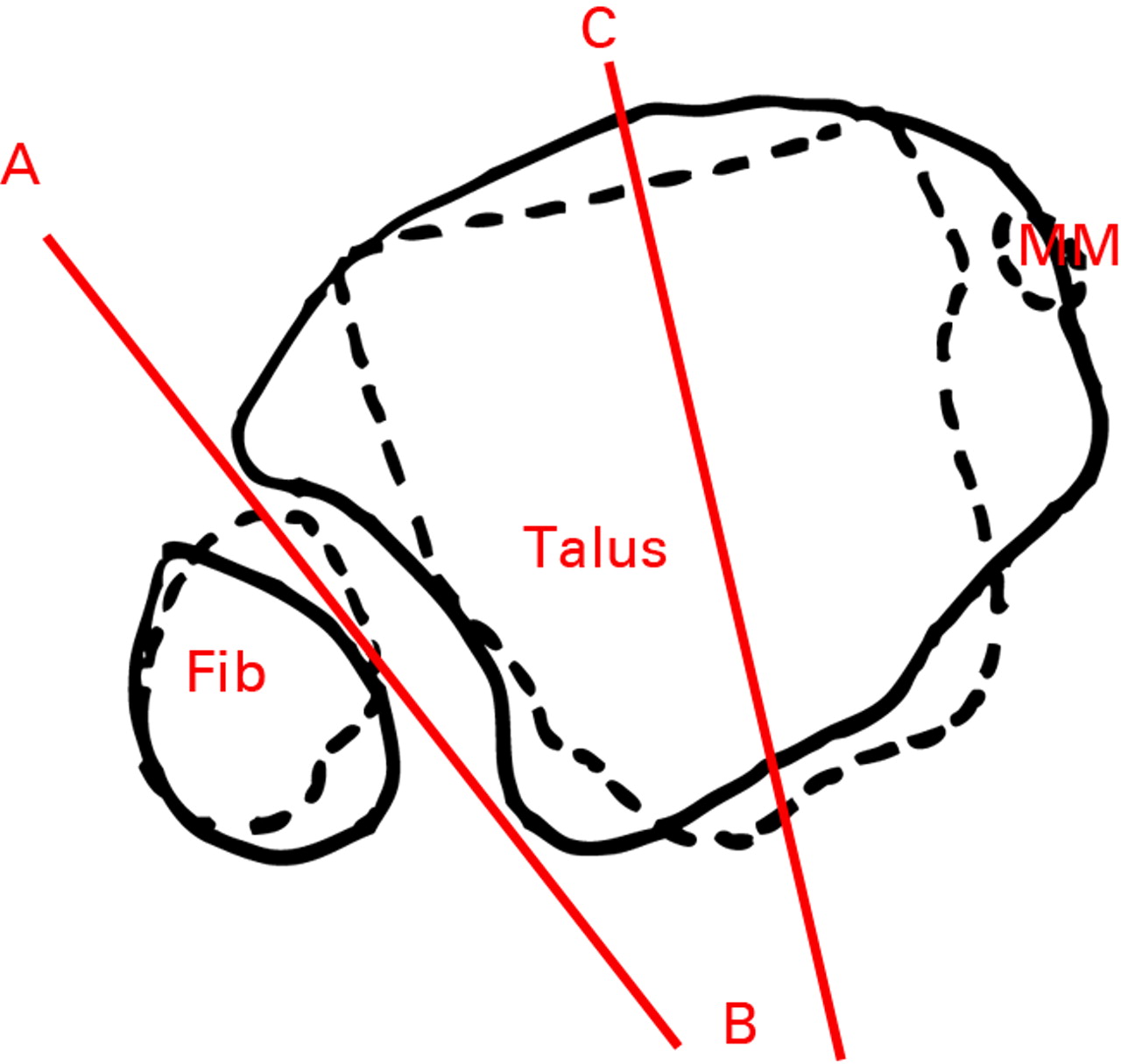 Figs. 4a - 4c 
          
            Figure 4a – diagram of a mortise
view showing approximate levels of axial slices shown in the diagrams in
Figures 4b and 4c. Line 1 is represented by solid lines and Line
2 represented by dotted lines in Figures 4b and 4c. Line 3 is the
line between the tips of the medial and lateral malleoli (intermalleoli
line). Figures 4b and 4c – diagrams of superimposed axial slices
for b) measurement of the angle (ABC) between the diastasis (AB)
and the intermalleoli axis (BC), and c) measurement of the angle
(ABC) between the diastasis (AB) and the talus (BC) (MM, medial
malleolus).
        