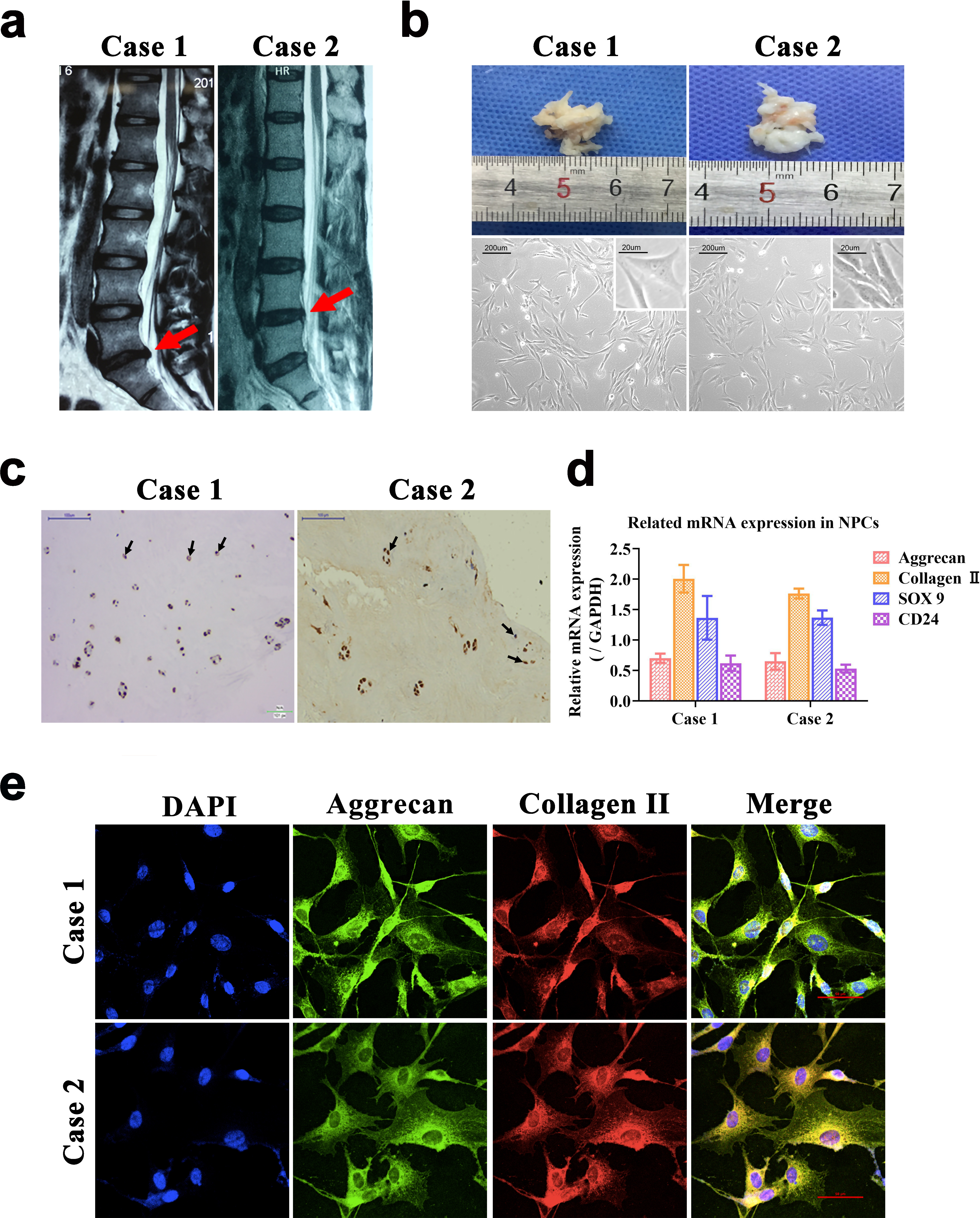 Fig. 1 
            Identification of nucleus pulposus cells (NPCs) isolated from patients with lumbar disc herniation (LDH). a) The MRI T2 weighted images show the intervertebral disc of the patients with LDH. Red arrows indicate the herniated disc. b) Macroscopic observation of nucleus pulposus tissues and microscopic observation of the cultured NPCs (magnification: ×100, scale bars = 200 μm). c) Caspase-1 in the nucleus pulposus tissue was detected by immunohistochemistry (magnification: ×200, scale bars = 100 μm). d) The mRNA expression of aggrecan, Collagen Ⅱ, SOX9, and CD24 was detected by reverse-transcription polymerase chain reaction. e) The immunofluorescence assay of collagen II and aggrecan of NPCs (magnification: ×600, scale bar = 50 μm). GAPDH, glyceraldehyde 3-phosphate dehydrogenase; mRNA, messenger RNA.
          