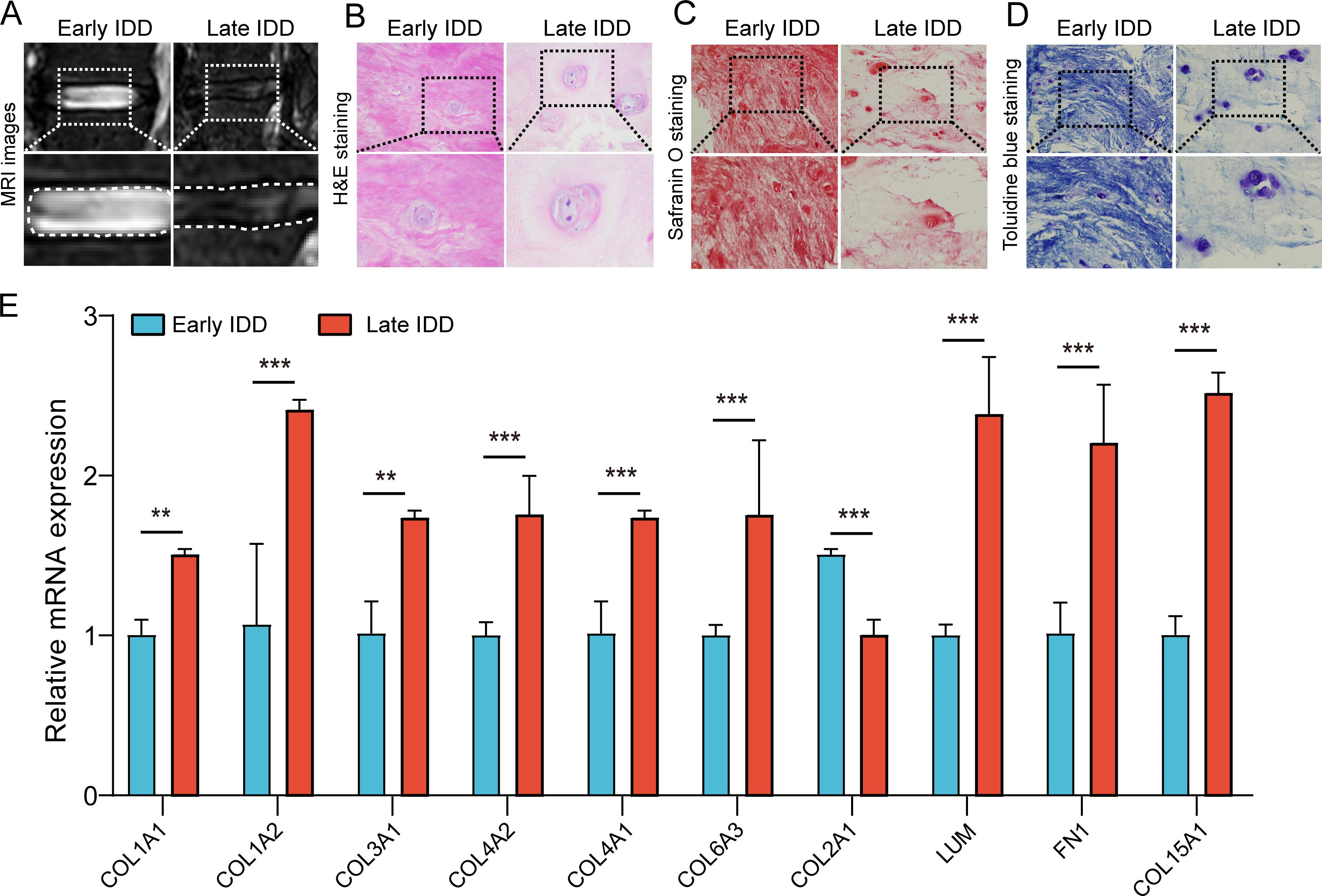 Fig. 7 
            Clinical surgical nucleus pulposus tissue sample collection and quantitative real-time polymerase chain reaction (qRT-PCR) analysis. a) Sagittal MRI T2-weighted images of the spine in intervertebral disc degeneration (IDD) patients (scale bar = 25 μm). b) Haematoxylin and eosin (H&E) staining of nucleus pulposus tissue of both groups of patients. Magnification: 40× (scale bar = 25 μm). c) Safranin O–Fast Green staining of nucleus pulposus tissue of both groups of patients. Magnification: 40× (scale bar = 25 μm). d) Toluidine blue staining of nucleus pulposus tissue of both groups of patients. Magnification: 40× (scale bar = 25 μm). e) The qRT-PCR analysis of top ten hub genes. Data were presented as the mean and standard deviation (SD). Independent-samples t-test was used for the statistical analysis of the two groups (**p < 0.01, ***p < 0.001).
          