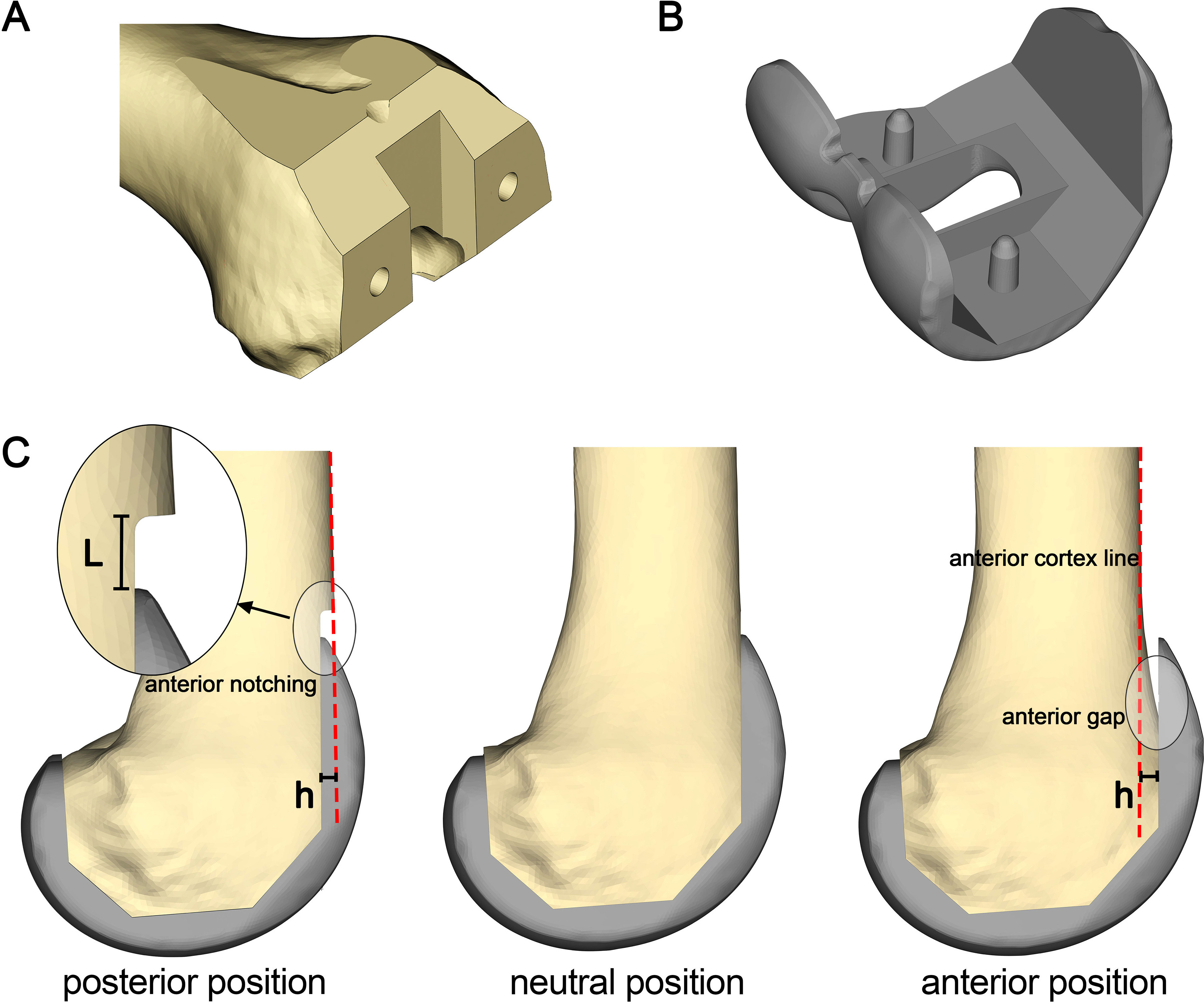 Fig. 1 
          Illustration of finite element analysis models and different sagittal positioning of the femoral component. a) The femur model. b) The femoral component of the high flexion posterior stable prosthesis. c) Different sagittal positioning of the femoral component. The anterior positioning causes a gap, and the posterior positioning causes a notch. ‘L’ represents the distance between the anterior flange of the femoral component and the notch, and 'h' represents the sagittal position of the femoral component.
        