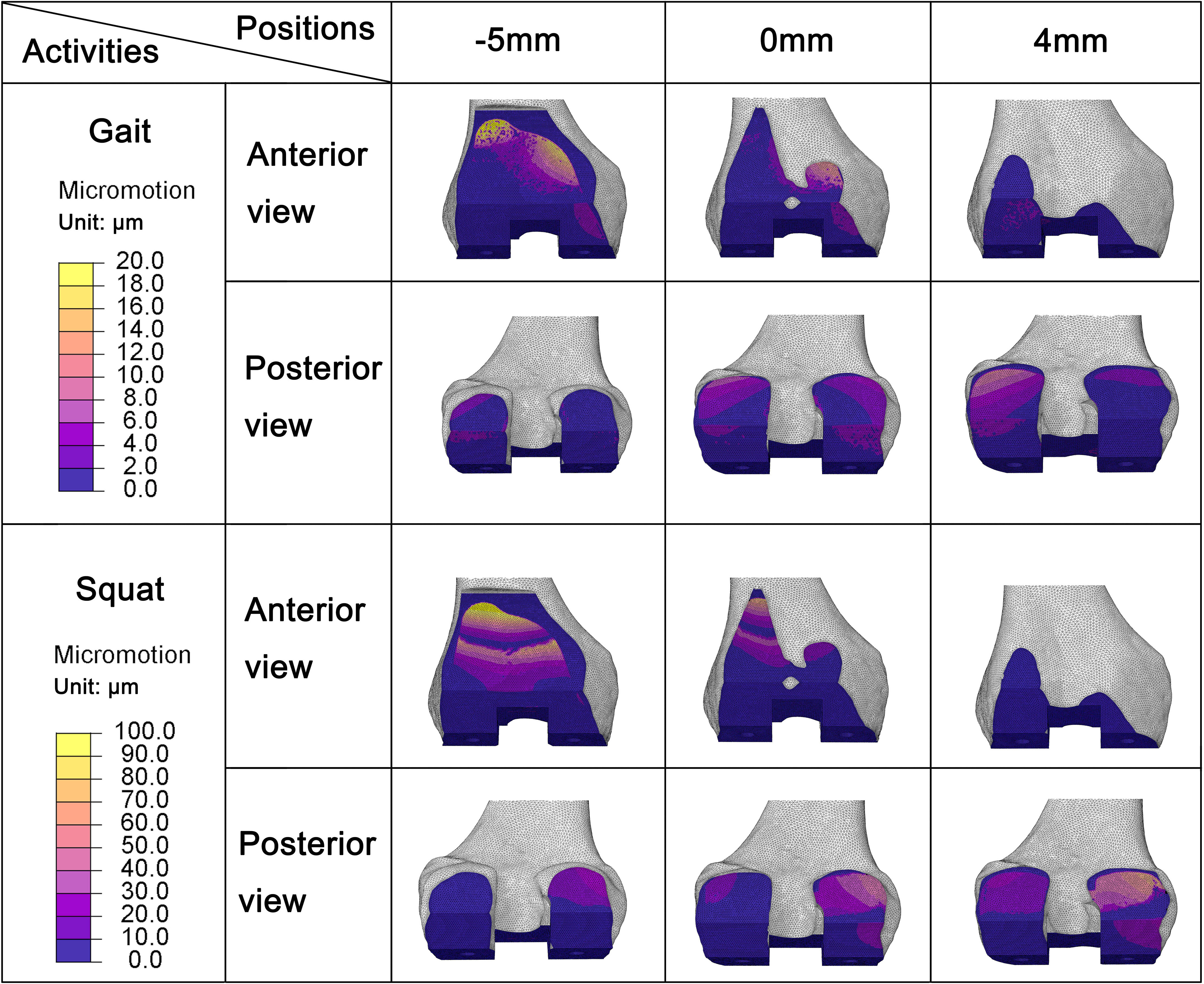 Fig. 8 
            Micromotion distribution at the femoral contact surface when the sagittal positioning of the femoral component was -5 mm, 0 mm, and 4 mm.
          