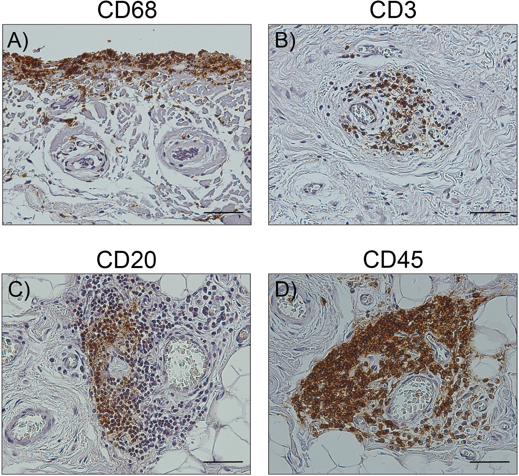 Fig. 8 
          Immunohistochemical staining of inflamed synovial tissue. Clinical specimens of synovial tissue from a representative omarthrosis (OmA) patient were histologically processed and stained with antibodies against a) CD68, b) CD3, c) CD20, or d) CD45. Immunopositive cells are shown in brown colour. Scale bars: 50 µm.
        