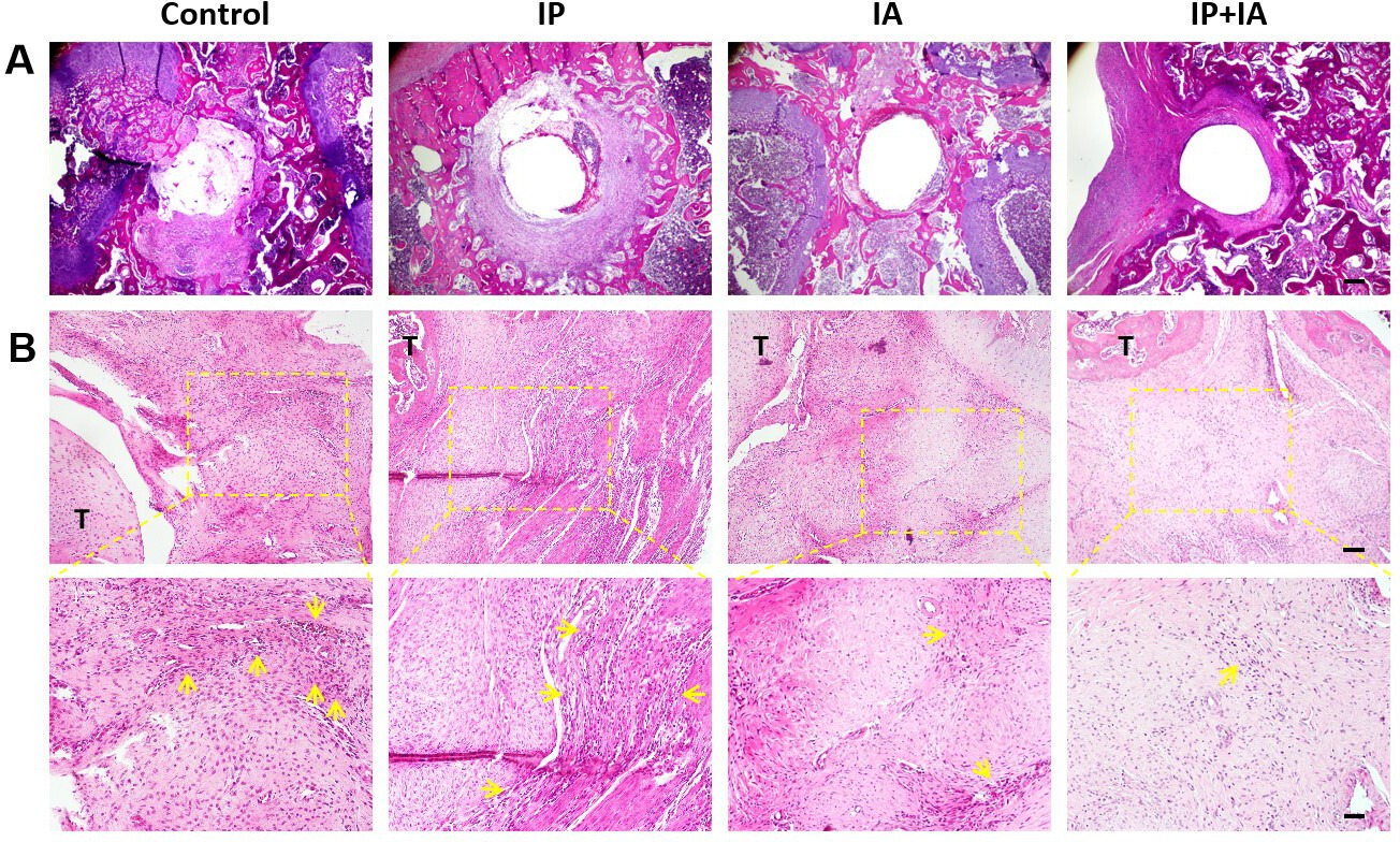 Fig. 5 
            Histopathological assessment of haematoxylin and eosin-stained knee joints from periprosthetic joint infection rats two weeks after one-stage revision. a) Degree of periprosthesis bone destruction in femur sagittal cross-sections. Scale bar, 200 μm. b) Knee joint (tibia and joint capsule) sagittal cross-sections. Scale bar, 100 μm (top panels) or 50 μm (bottom panels). The arrows point to inflammatory cells. T, tibia.
          